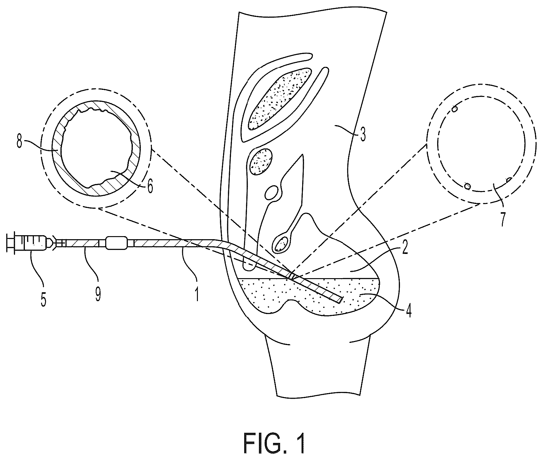 Patent US12569892 Figure 1 – Methods and compositions for decontaminating PD catheters