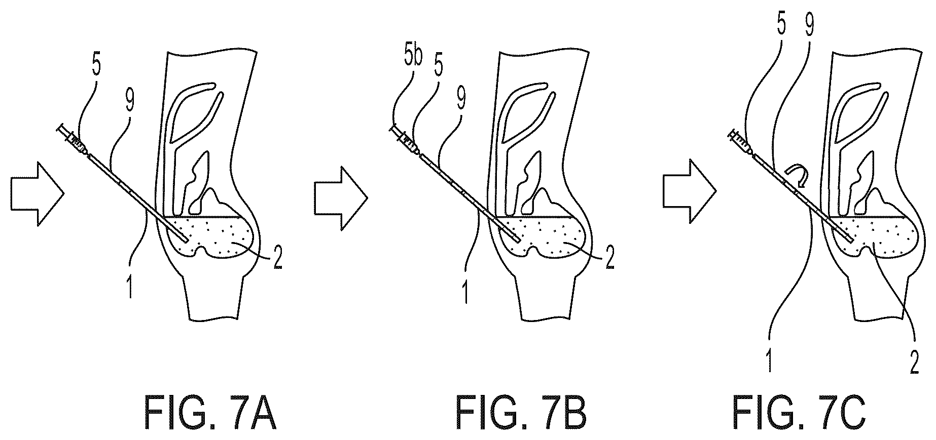 Patent US12569892 Figure 7 – Methods and compositions for decontaminating PD catheters