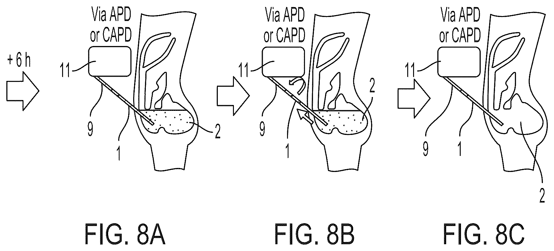 Patent US12569892 Figure 8 – Methods and compositions for decontaminating PD catheters
