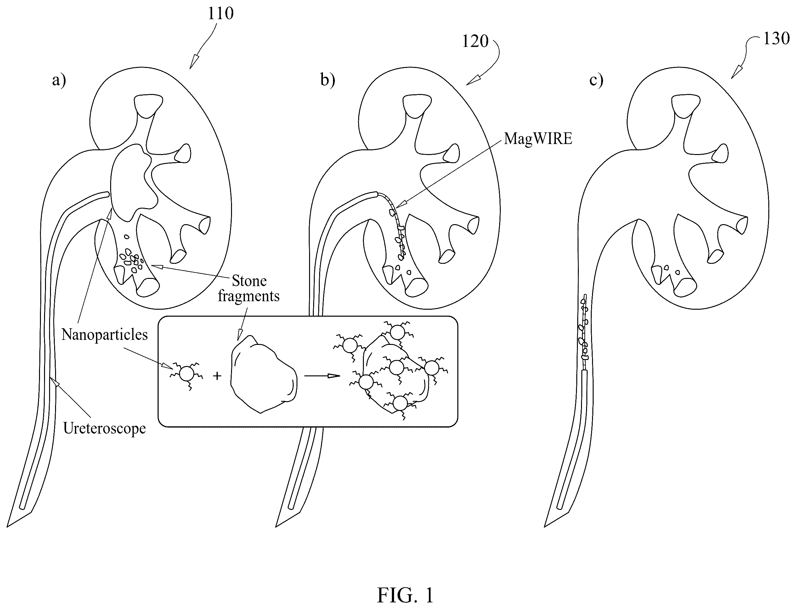 Patent US12576031 Figure 1 – Magnetic wire for retrieval and elimination of calculus from the urinary tract