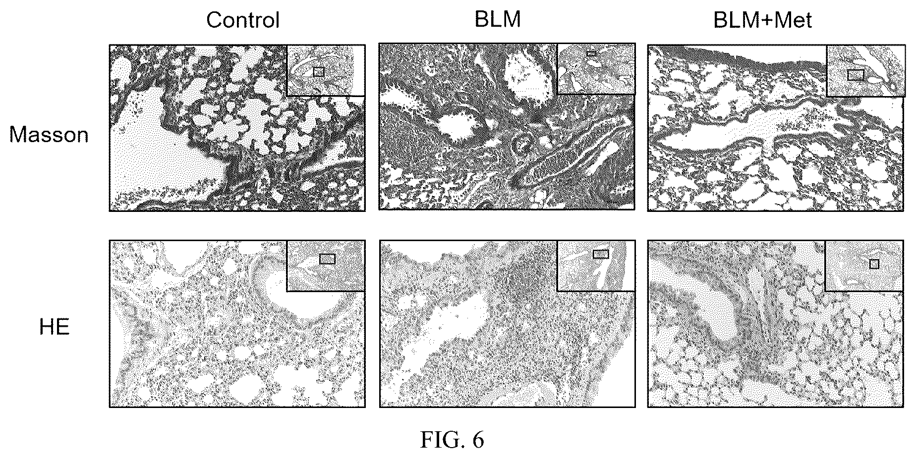 Patent US12576052 Figure 7 – Metformin inhalation powder aerosol for treating idiopathic pulmonary fibrosis and preparation method thereof