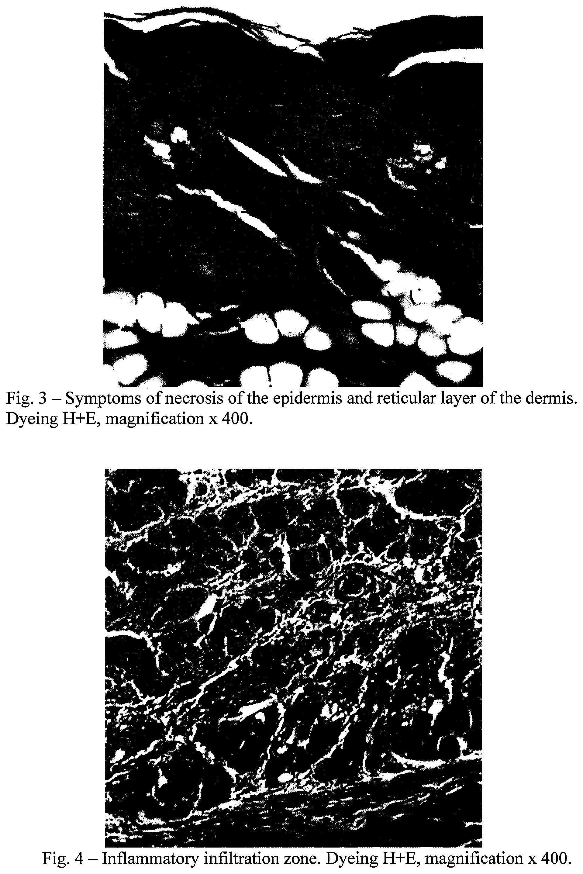 Patent US12576053 Figure 3 – Use of 2-[(3Z)-6-fluoro-2-methyl-3-[(4-methylsulfinylphenyl) methylidenejinden-1-yl] acetic acid