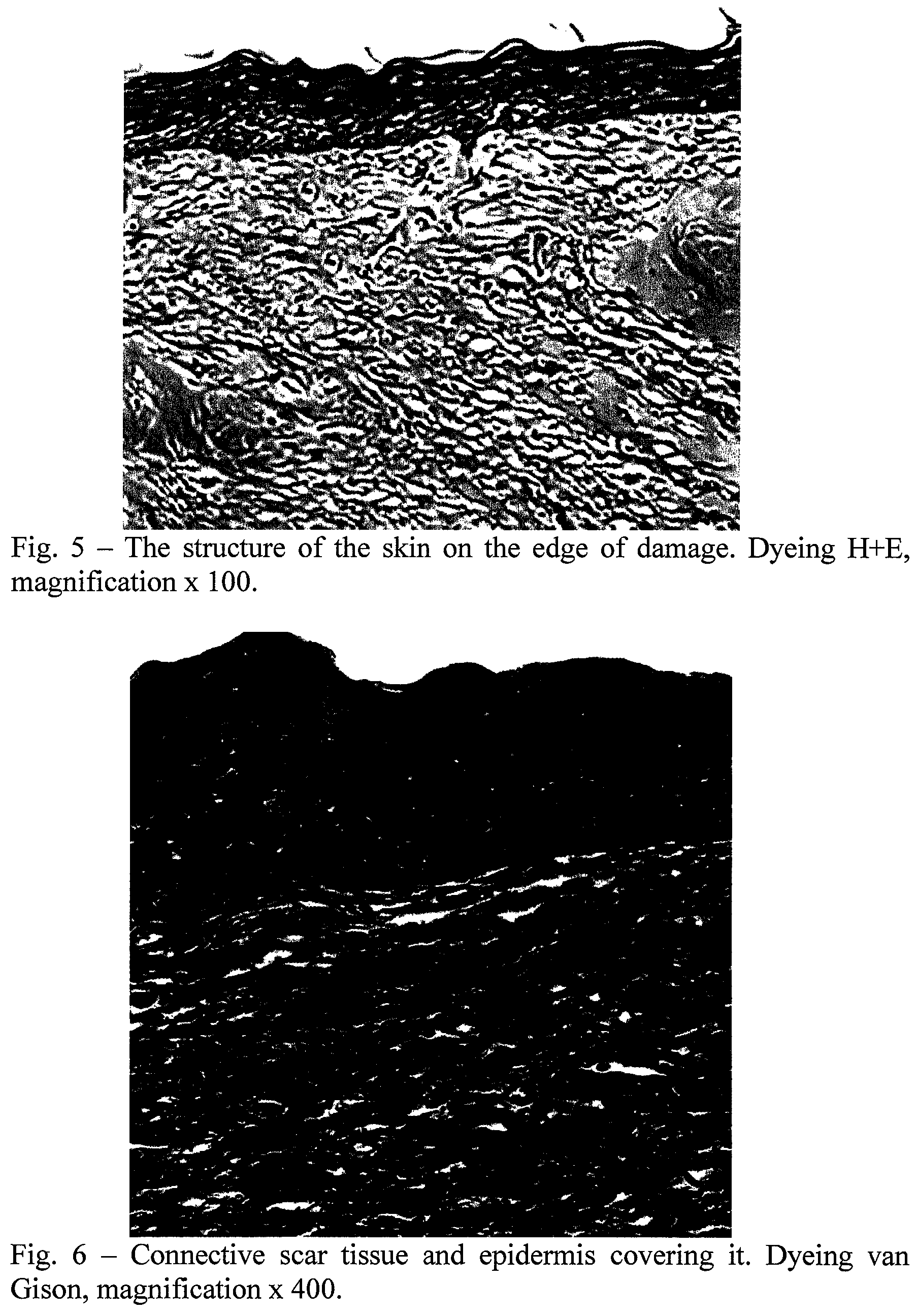 Patent US12576053 Figure 4 – Use of 2-[(3Z)-6-fluoro-2-methyl-3-[(4-methylsulfinylphenyl) methylidenejinden-1-yl] acetic acid