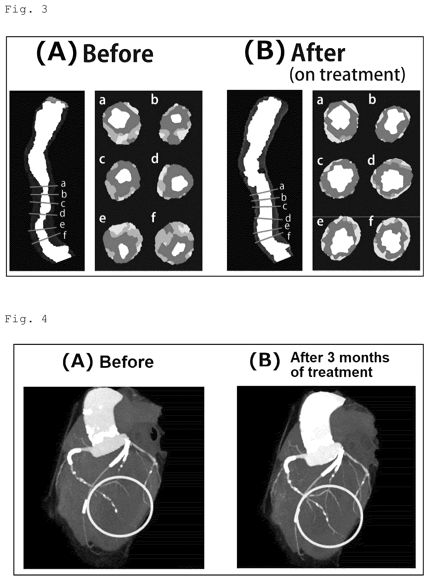 Patent US12576061 Figure 3 – Agent for inducing regression of triglyceride deposit atherosclerosis