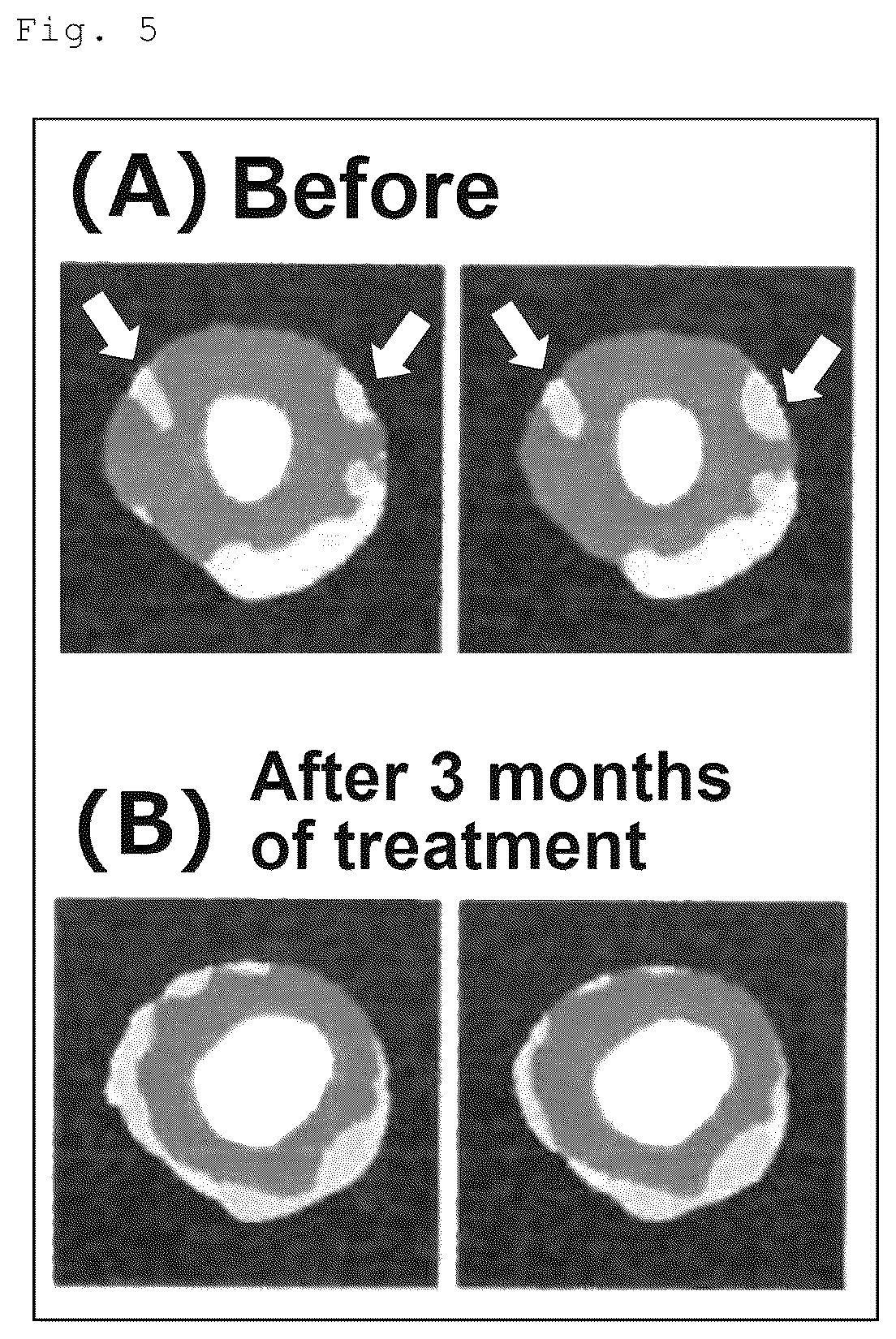 Patent US12576061 Figure 4 – Agent for inducing regression of triglyceride deposit atherosclerosis
