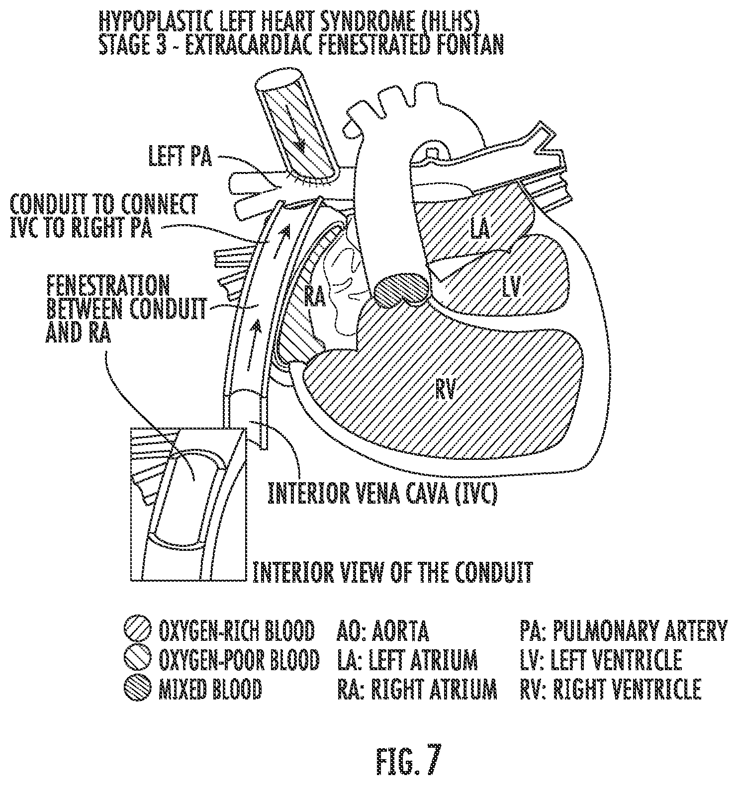 Patent US12576081 Figure 11 – Methods and compositions for improving exercise performance, single ventricular performance, cardiac output and myocardial performance index (MPI) in single ventricular heart disease, using udenafil compositions