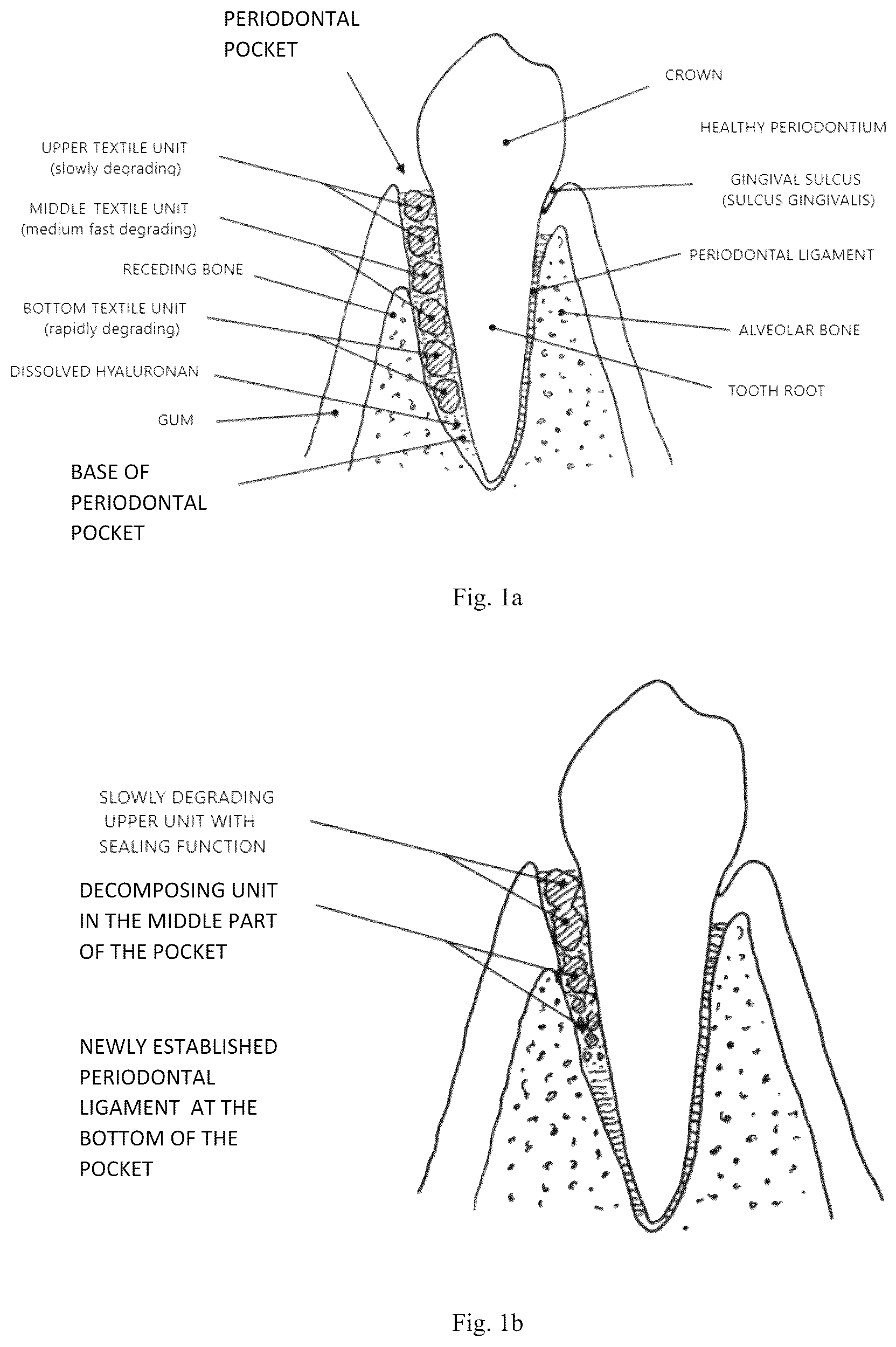 Patent US12576104 — Dental preparation comprising fibers based on hyaluronic acid with regulated biodegradability — Figure 1