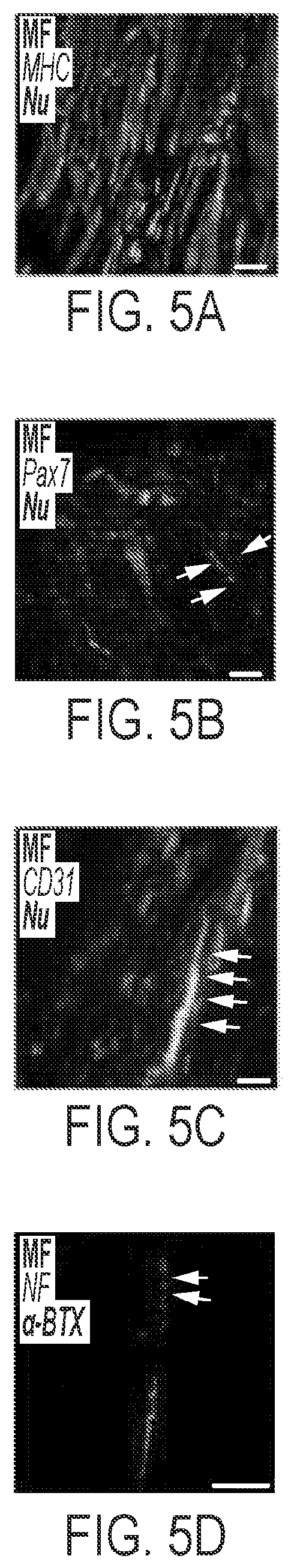 Patent US12576113 Figure 4 – Rotator cuff therapy using muscle fiber fragments