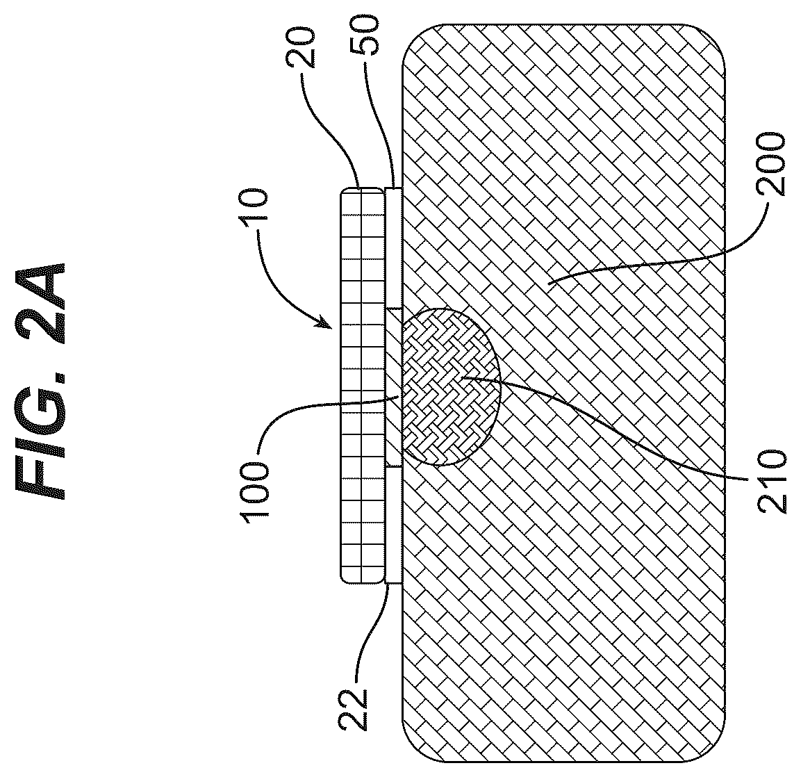 Patent US12576182 Figure 2 – Absorbable dressings for sealing sensitive neural tissue and dura matter