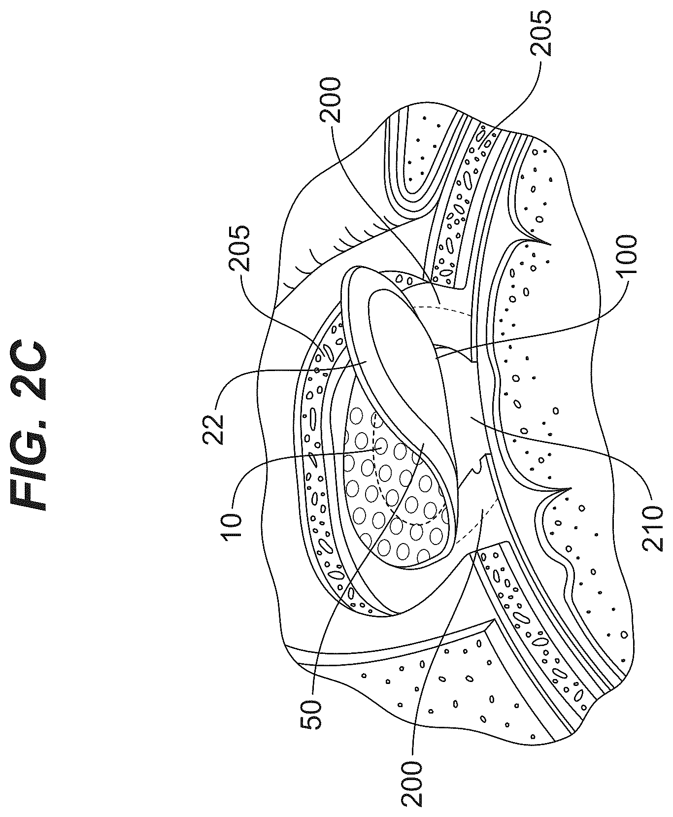 Patent US12576182 Figure 4 – Absorbable dressings for sealing sensitive neural tissue and dura matter
