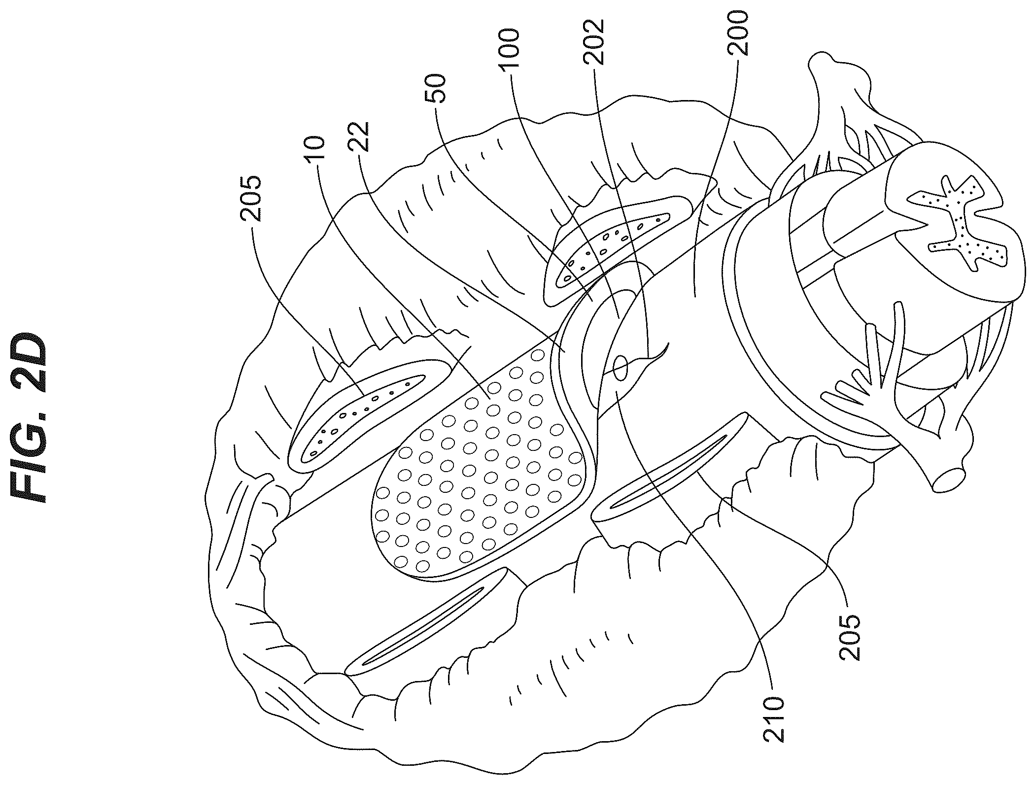 Patent US12576182 Figure 5 – Absorbable dressings for sealing sensitive neural tissue and dura matter