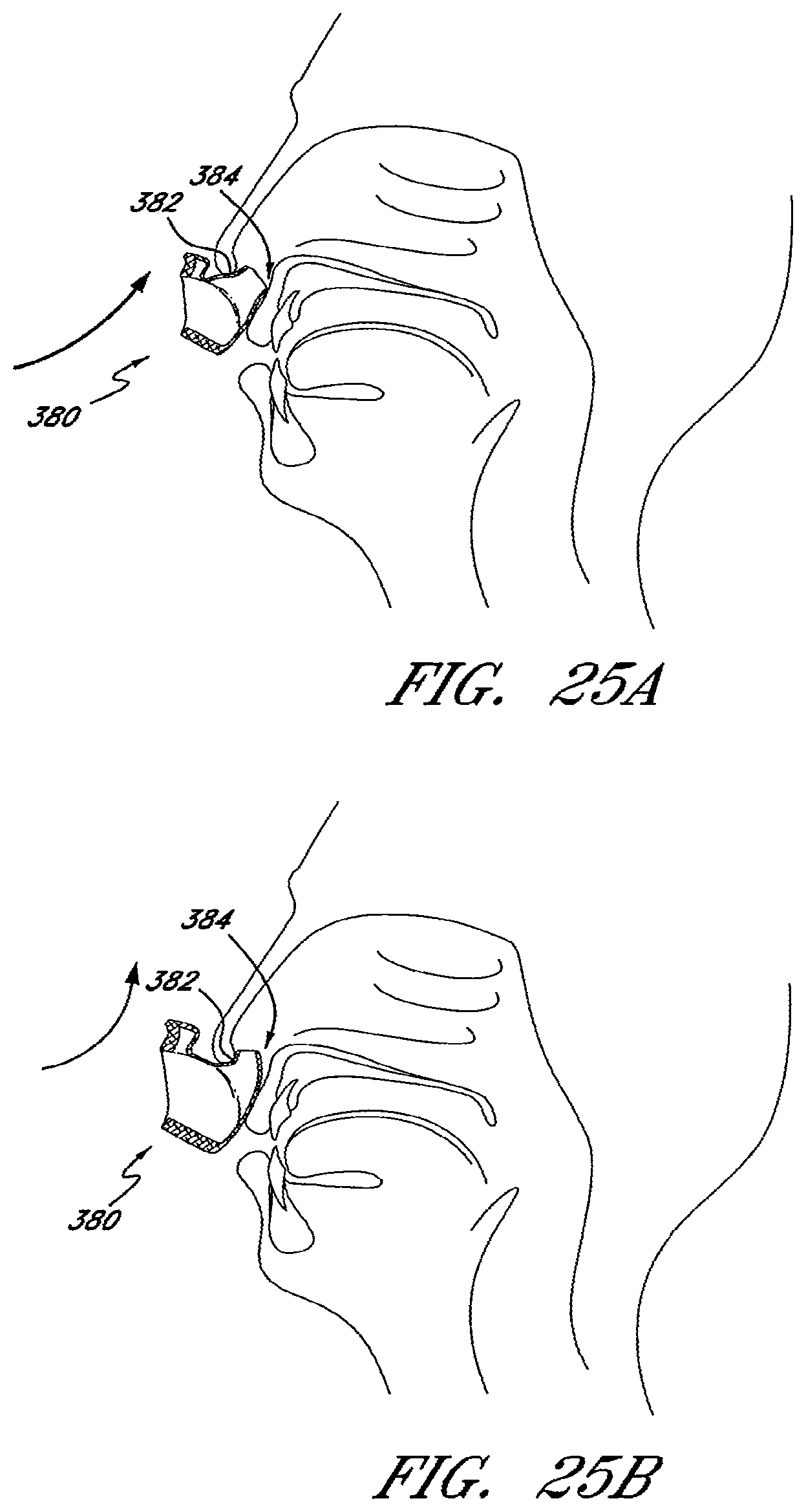 Patent US12576230 Figure 17 – Patient interface and aspects thereof