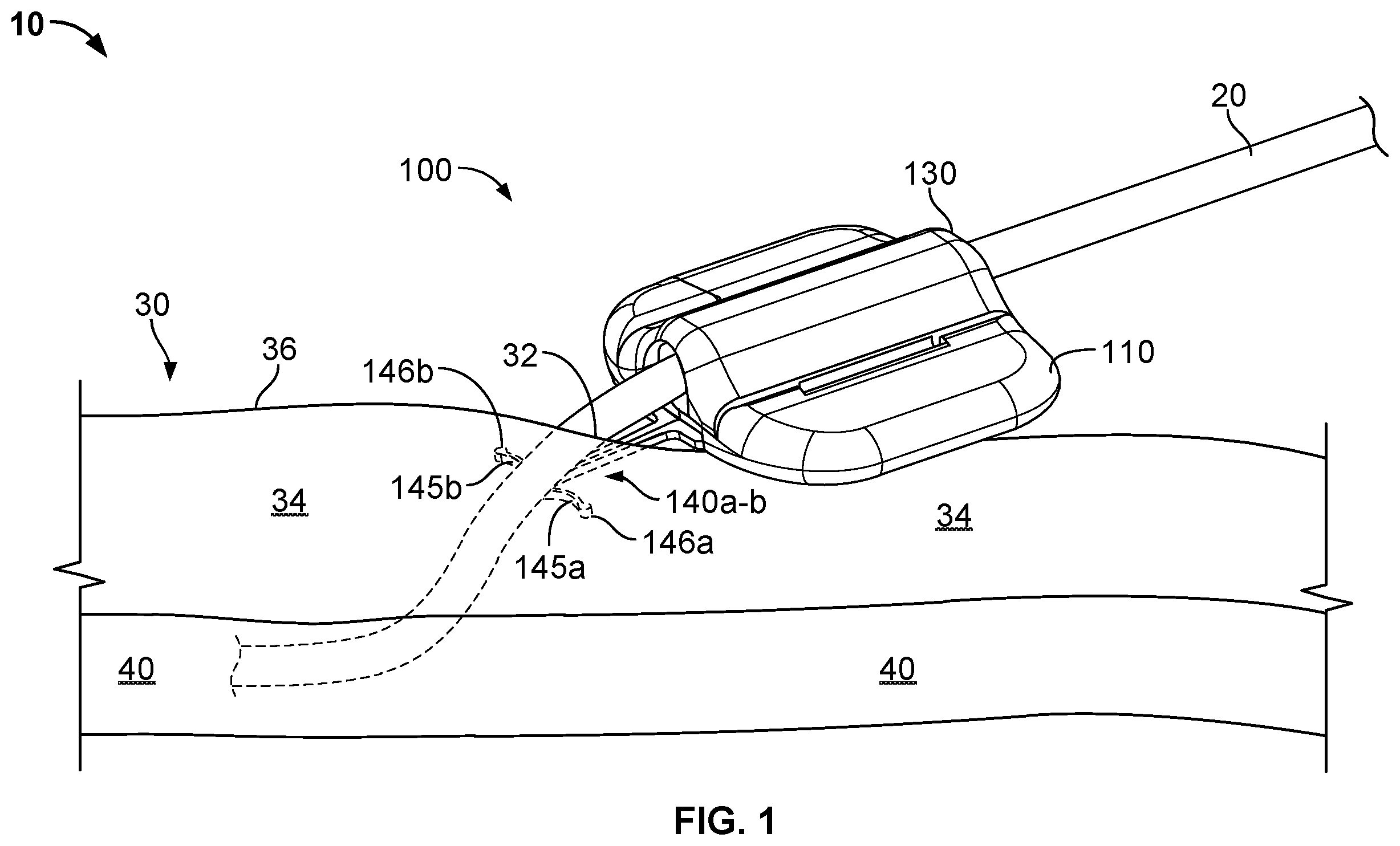 Patent US12576245 Figure 1 – Systems and methods for anchoring medical devices