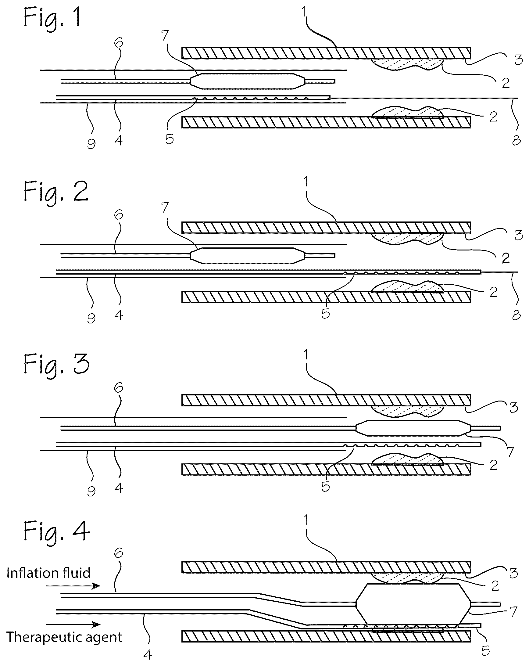 Patent US12576249 Figure 1 – Infusion catheter and balloon catheter system and method