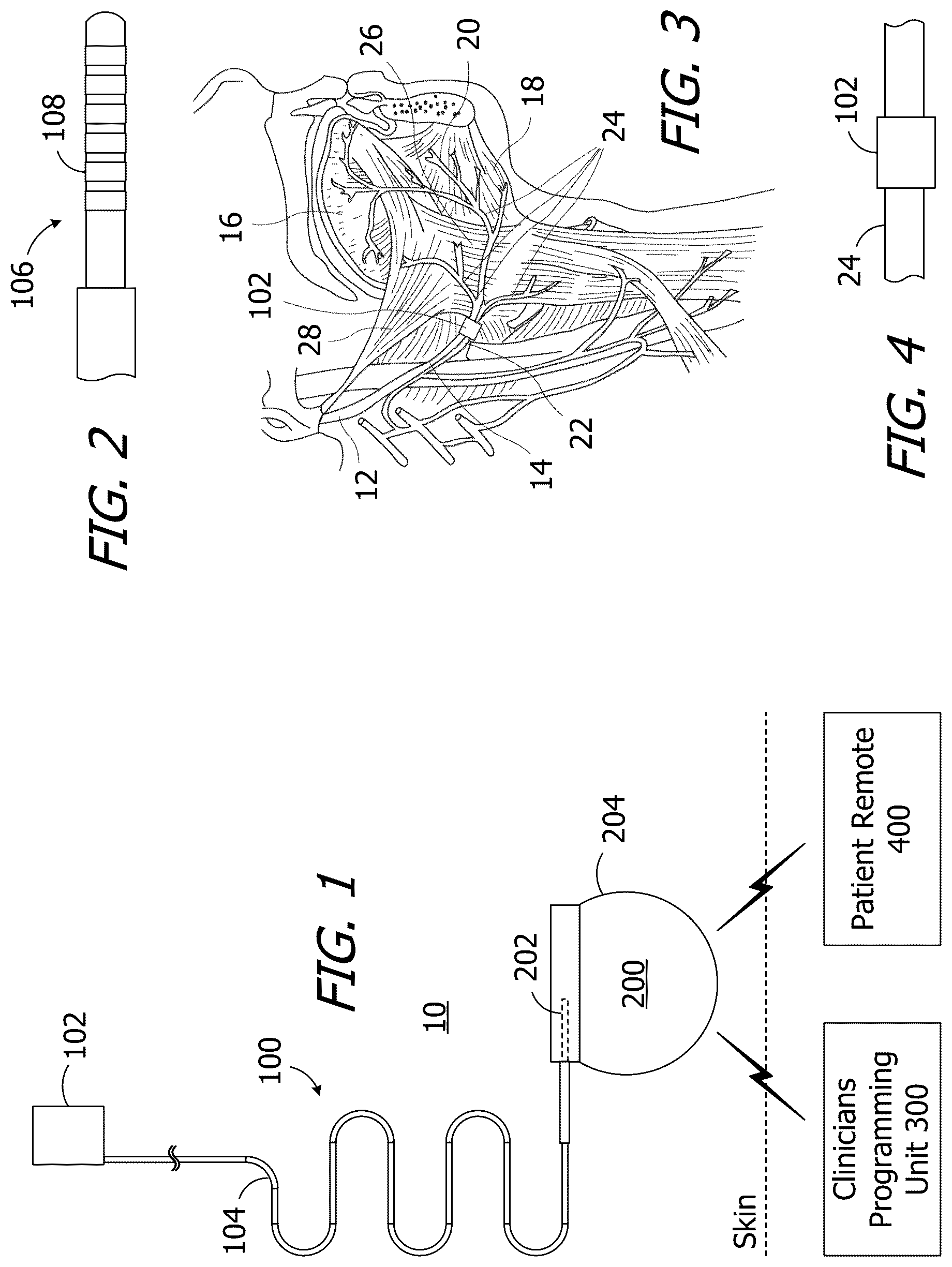 Patent US12576267 Figure 1 – Tissue stimulation apparatus and methods of making the same