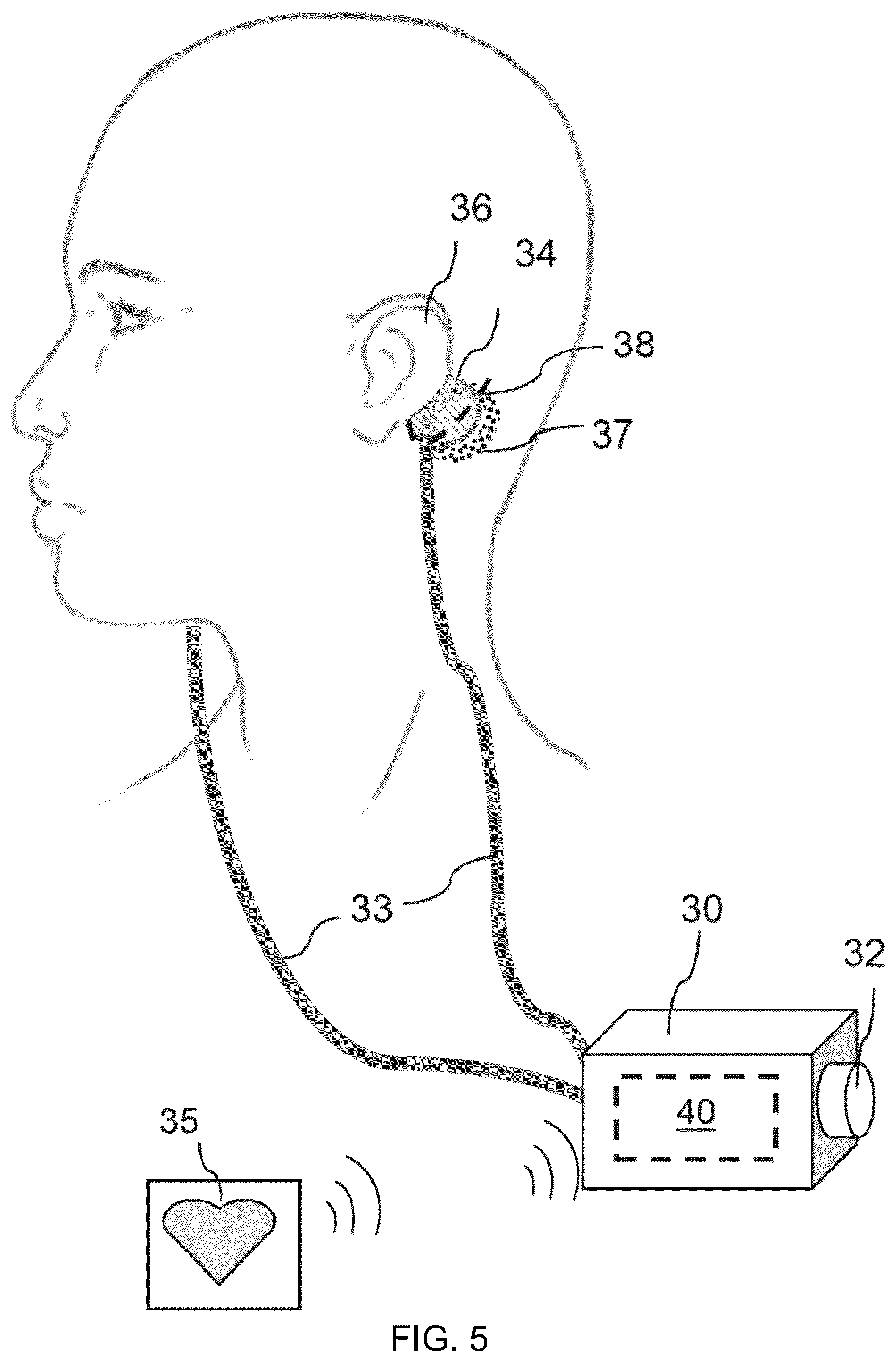 Patent US12576271 Figure 4 – Systems, devices and methods for anxiety treatment using vestibular nerve stimulation