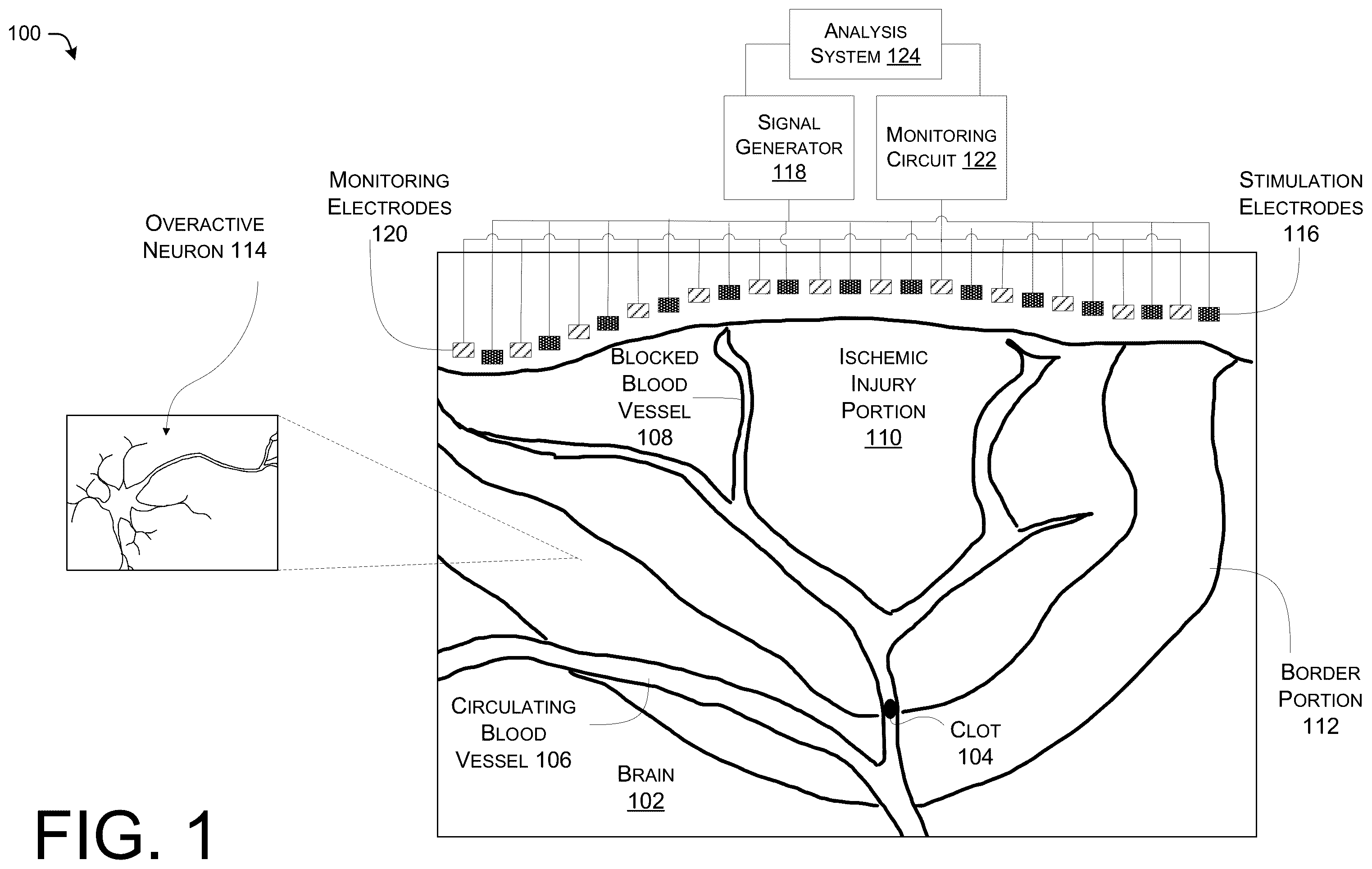Patent US12576274 Figure 1 – Treating stroke using electrical stimulation