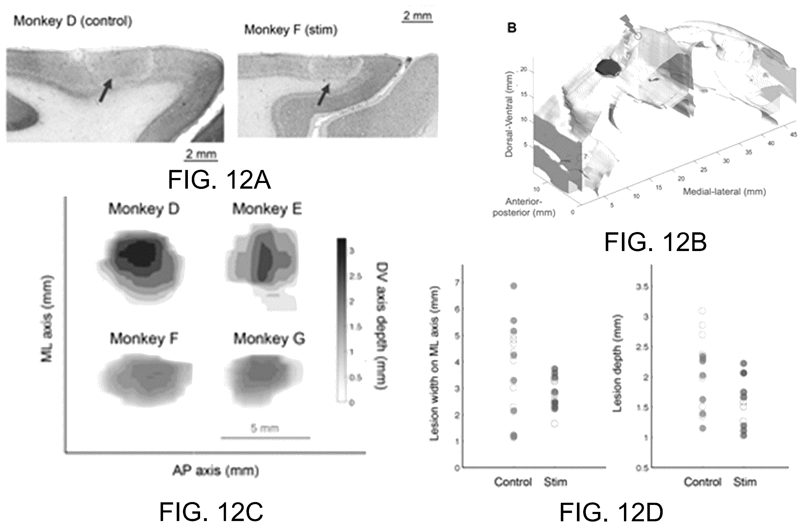 Patent US12576274 Figure 9 – Treating stroke using electrical stimulation