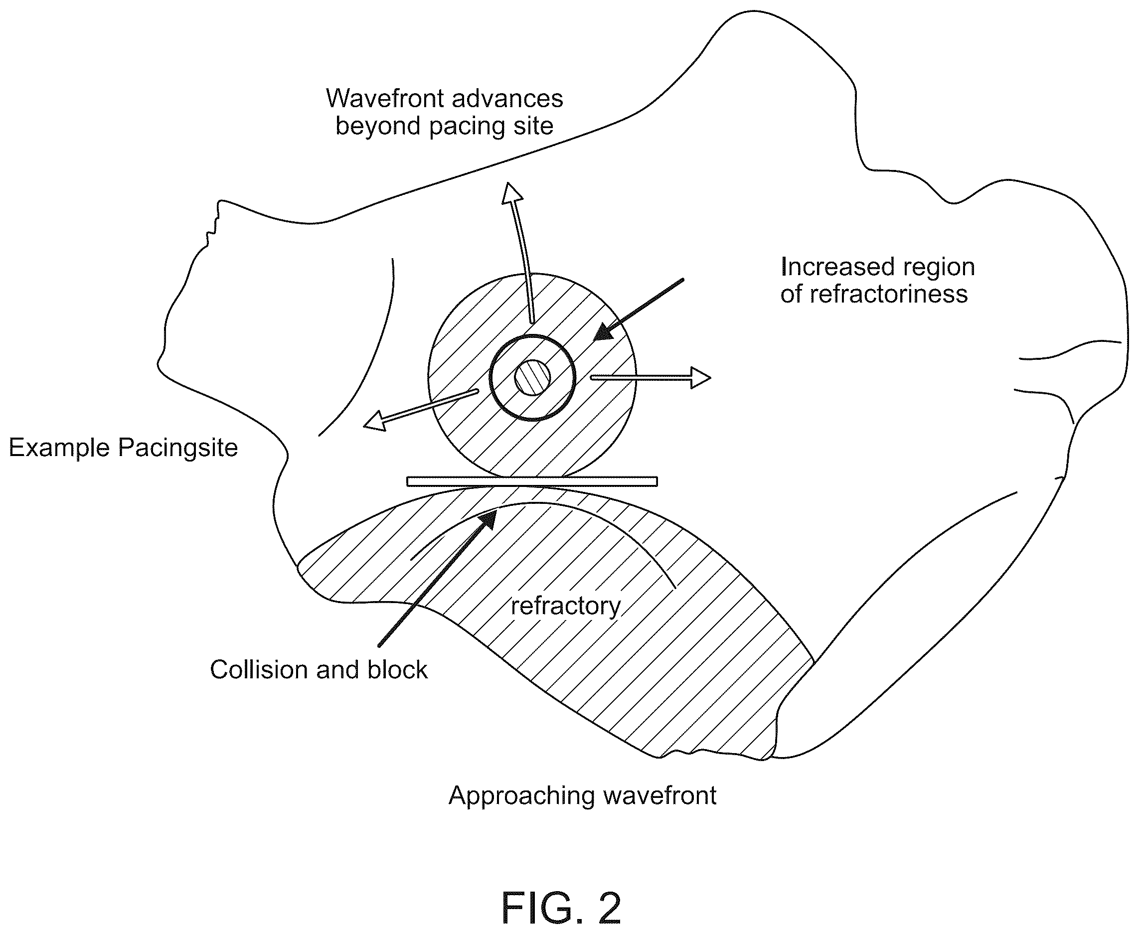 Patent US12576277 Figure 3 – Advanced pacing