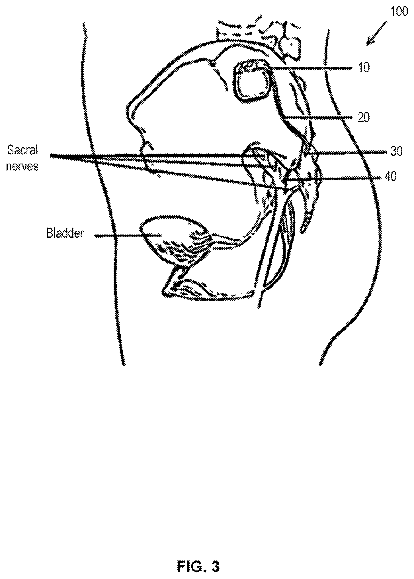 Patent US12576279 Figure 5 – Header for a neurostimulator