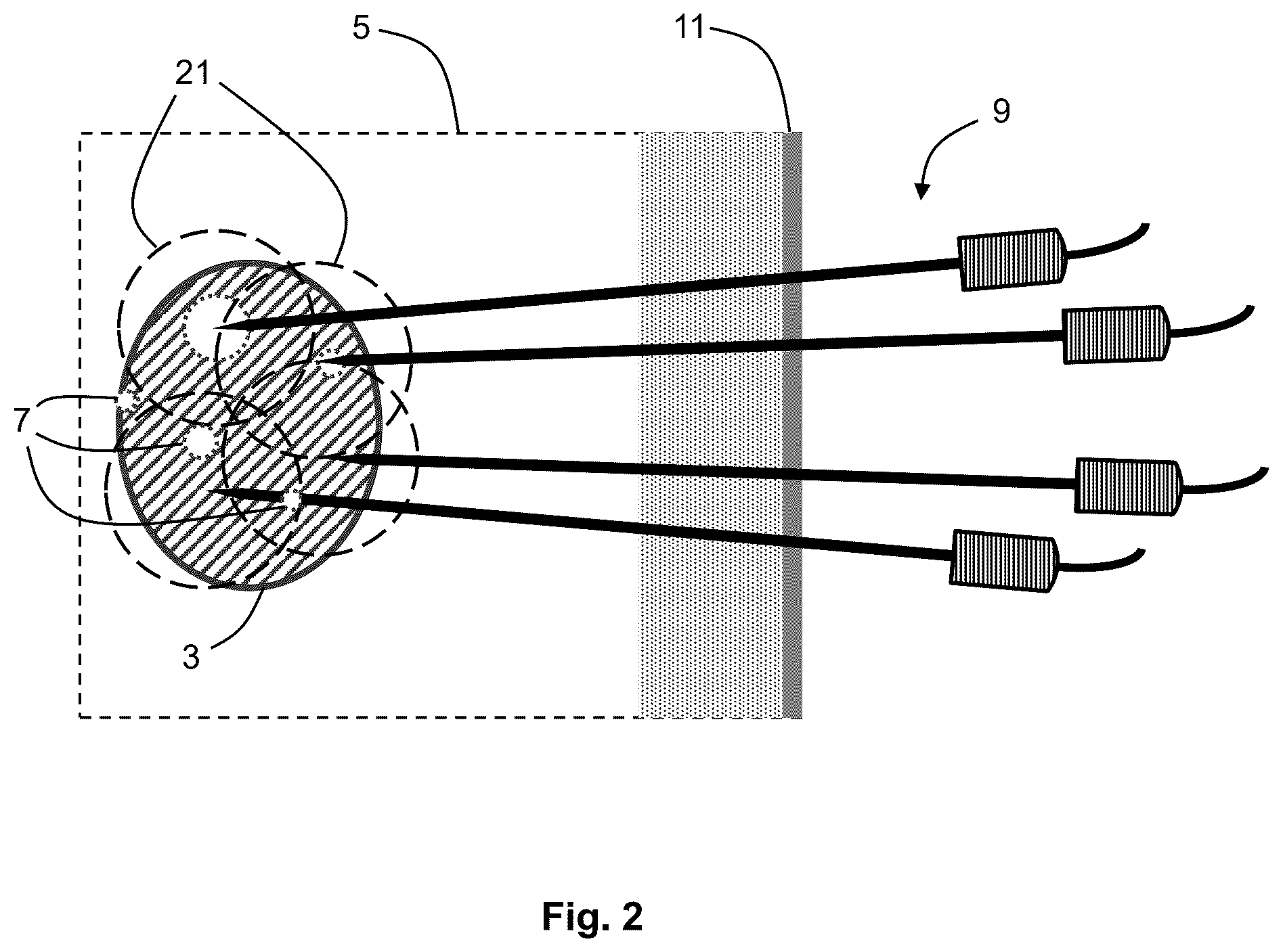 Patent US12576283 Figure 2 – System for performing transcutaneous photodynamic therapy (PDT) in an organ or organ segment of an organic body