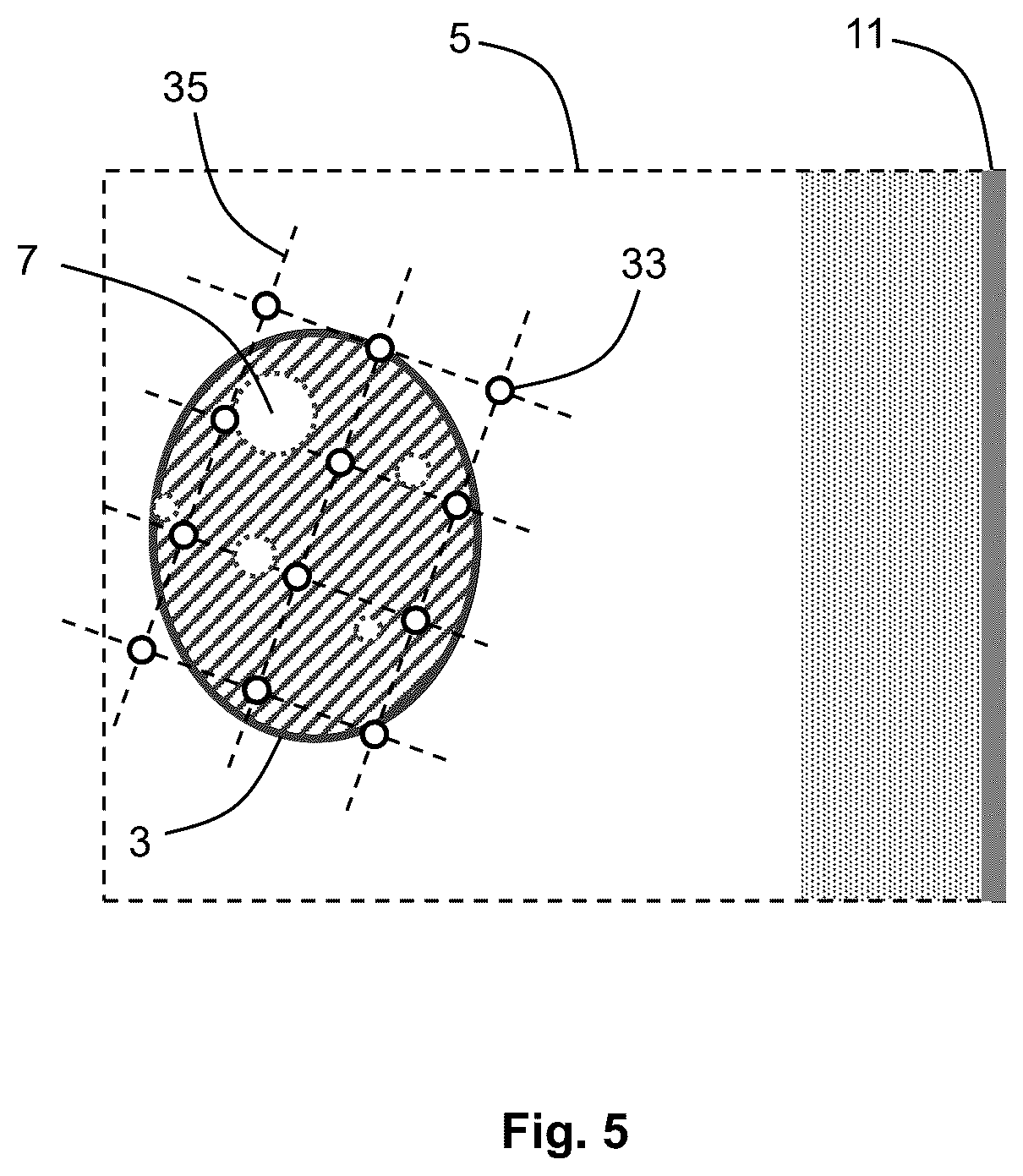 Patent US12576283 Figure 5 – System for performing transcutaneous photodynamic therapy (PDT) in an organ or organ segment of an organic body