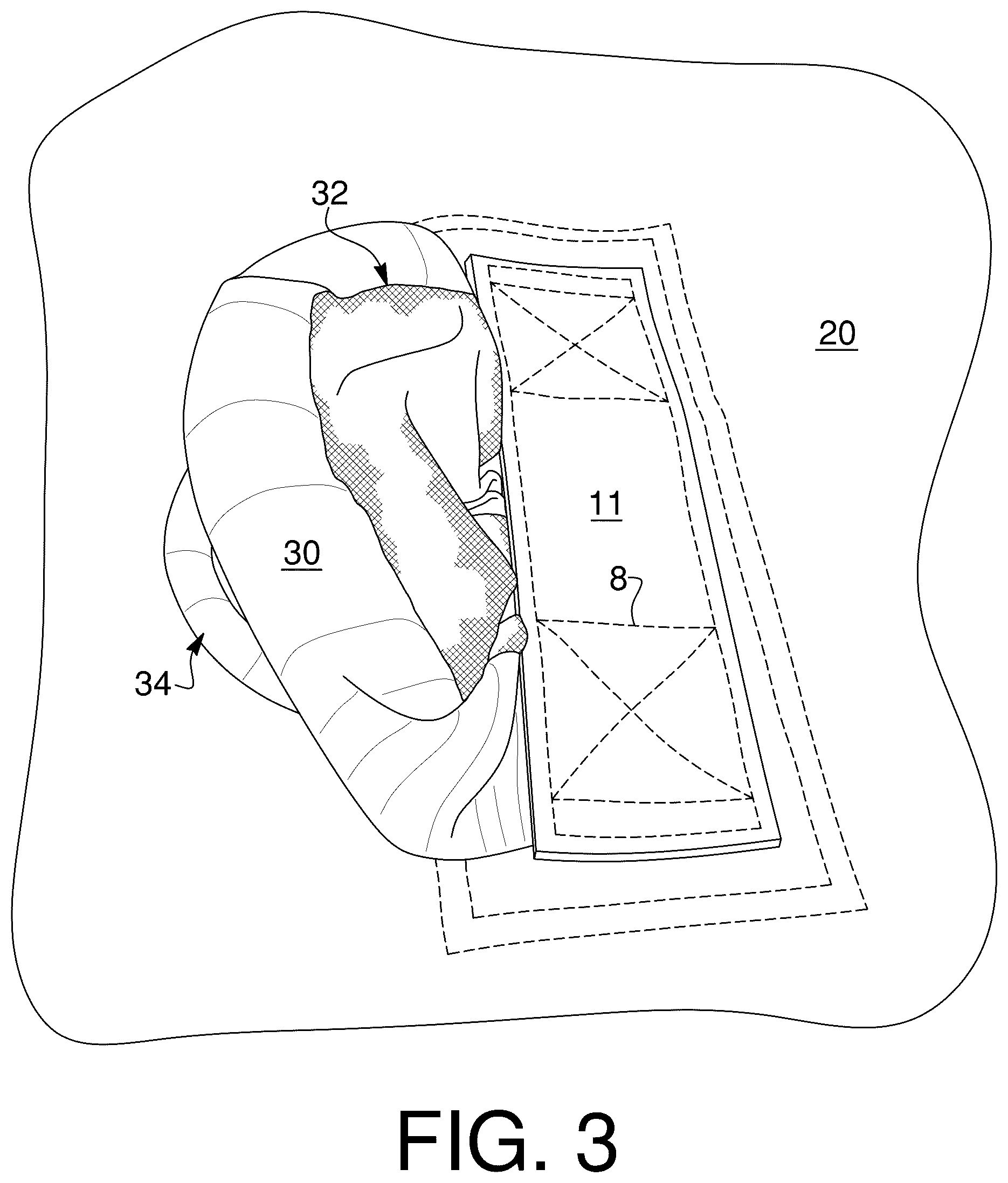 Patent US12576949 Figure 4 – User handle for watersports device