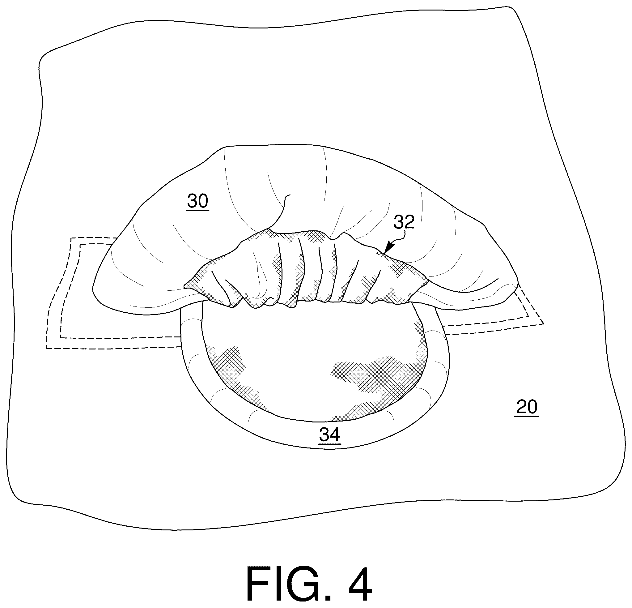 Patent US12576949 Figure 5 – User handle for watersports device