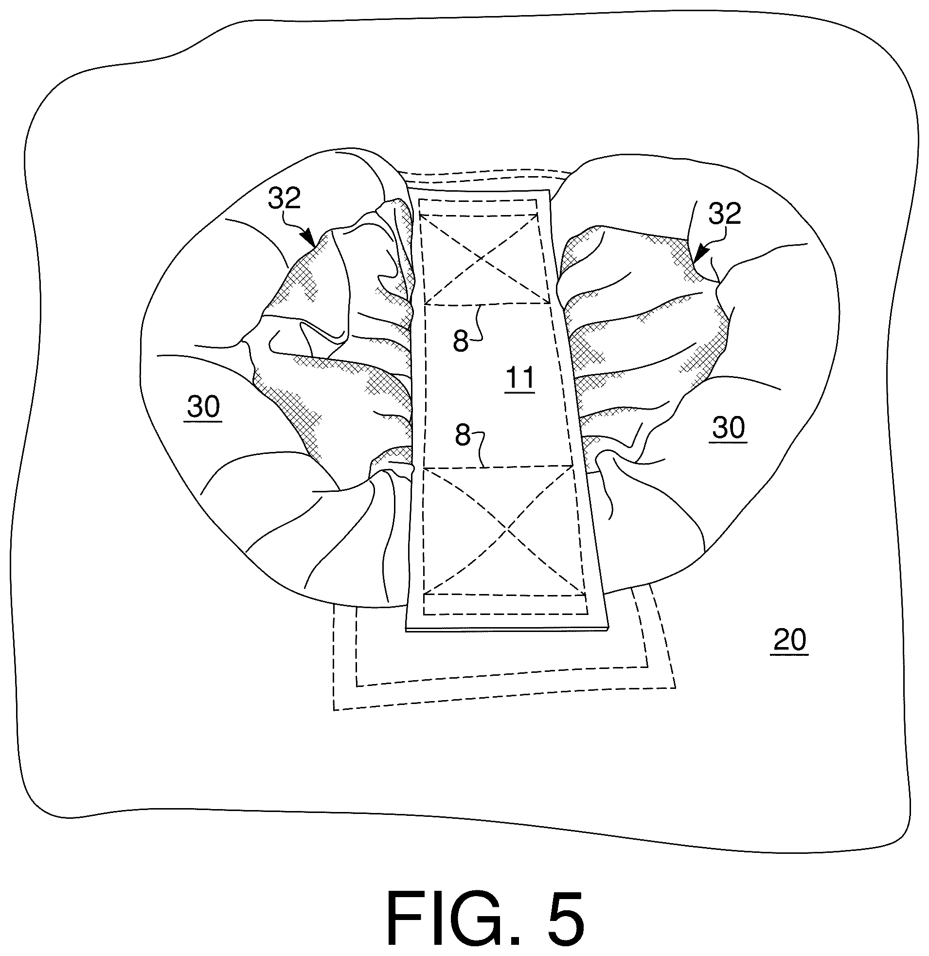 Patent US12576949 Figure 6 – User handle for watersports device