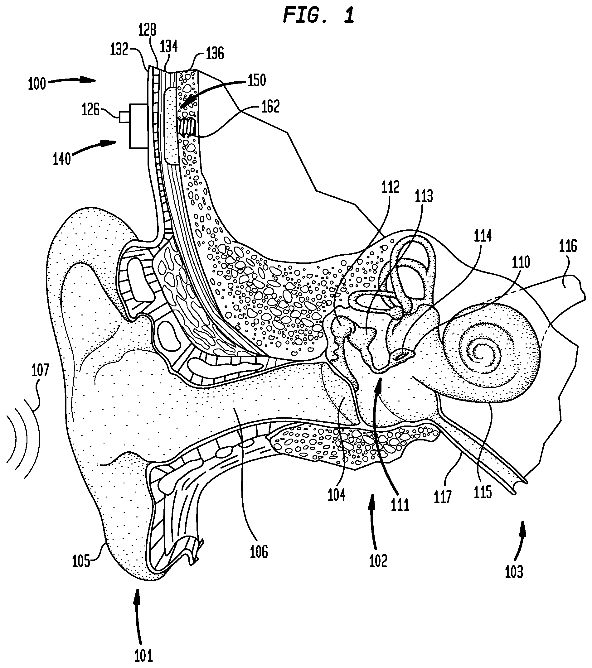Patent US12581254 Figure 1 – Convertibility of a bone conduction device