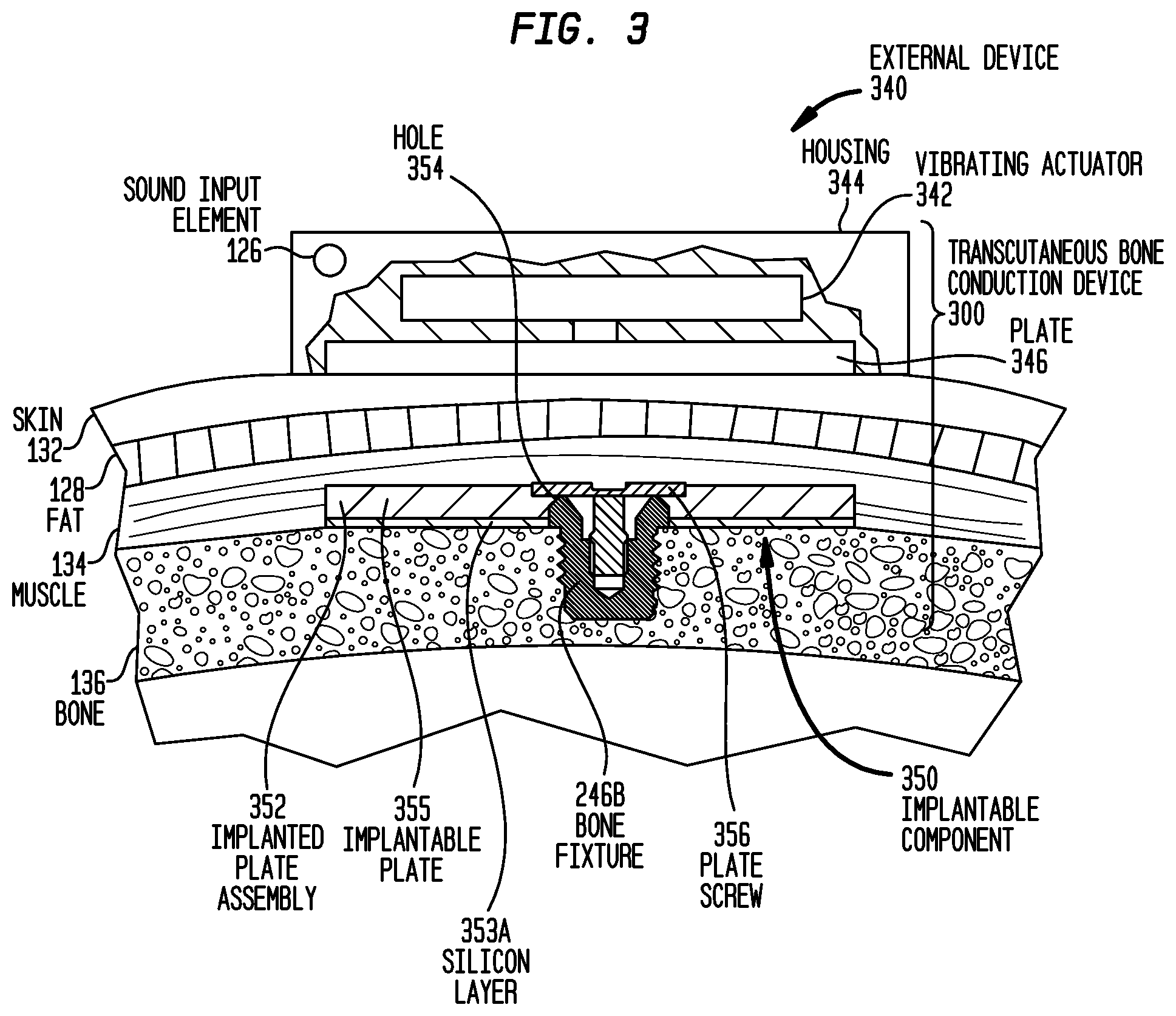 Patent US12581254 Figure 3 – Convertibility of a bone conduction device