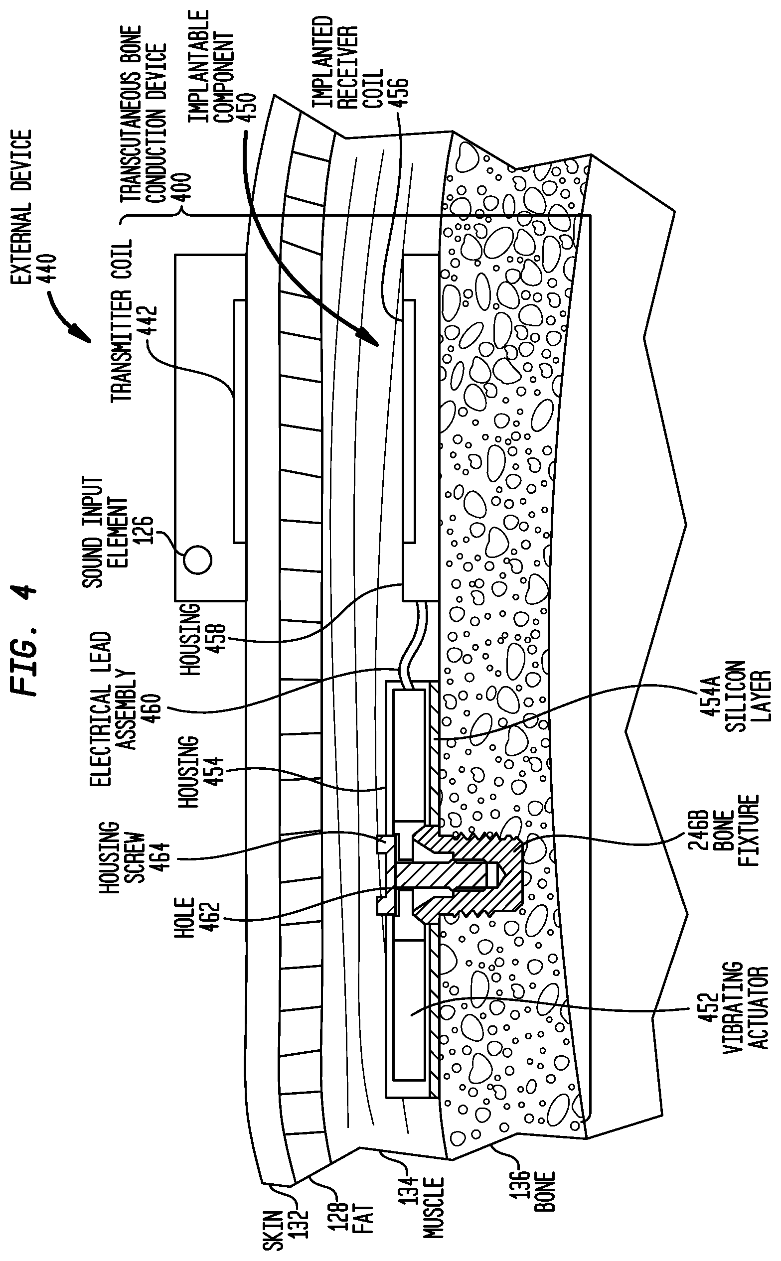 Patent US12581254 Figure 4 – Convertibility of a bone conduction device