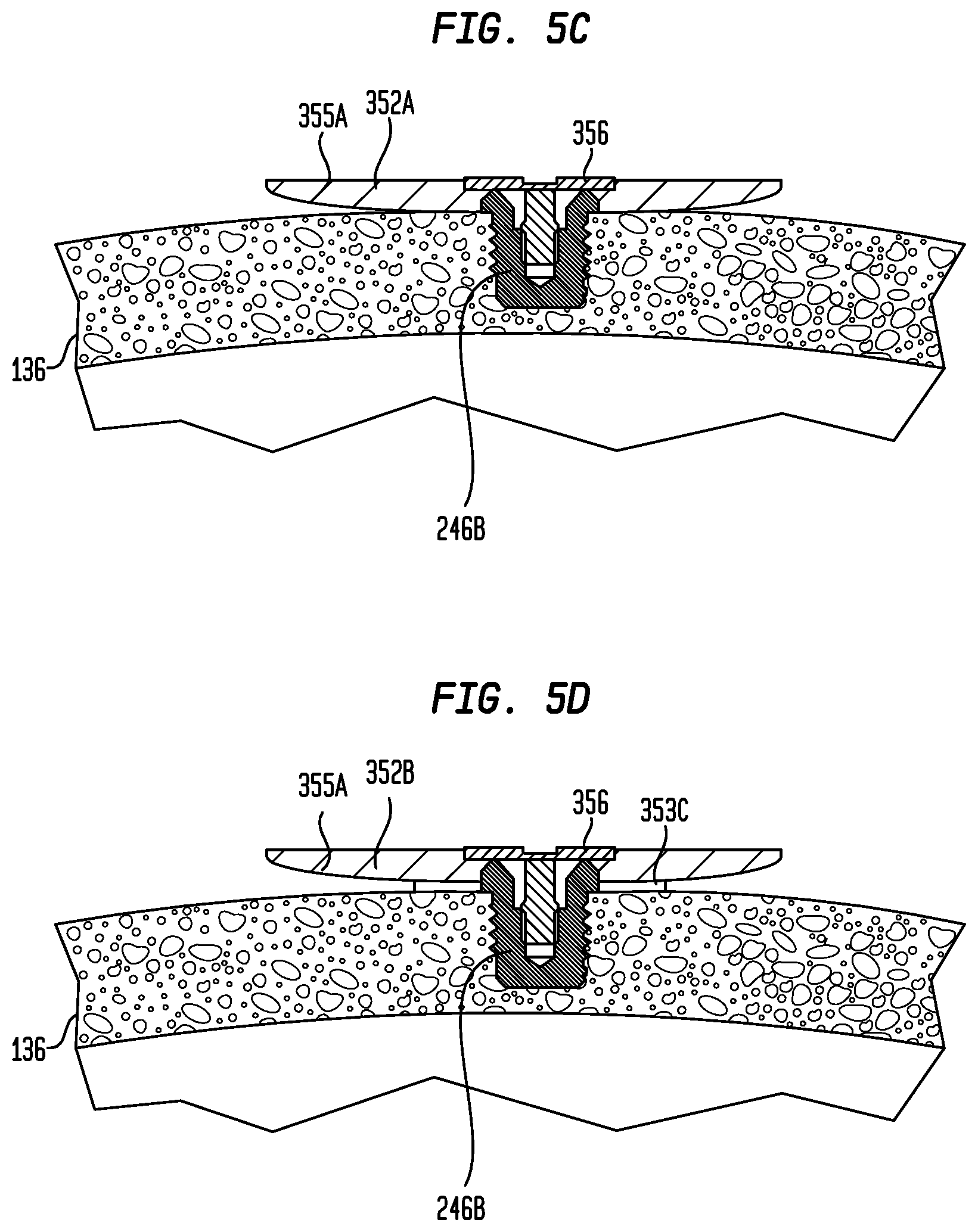 Patent US12581254 Figure 6 – Convertibility of a bone conduction device