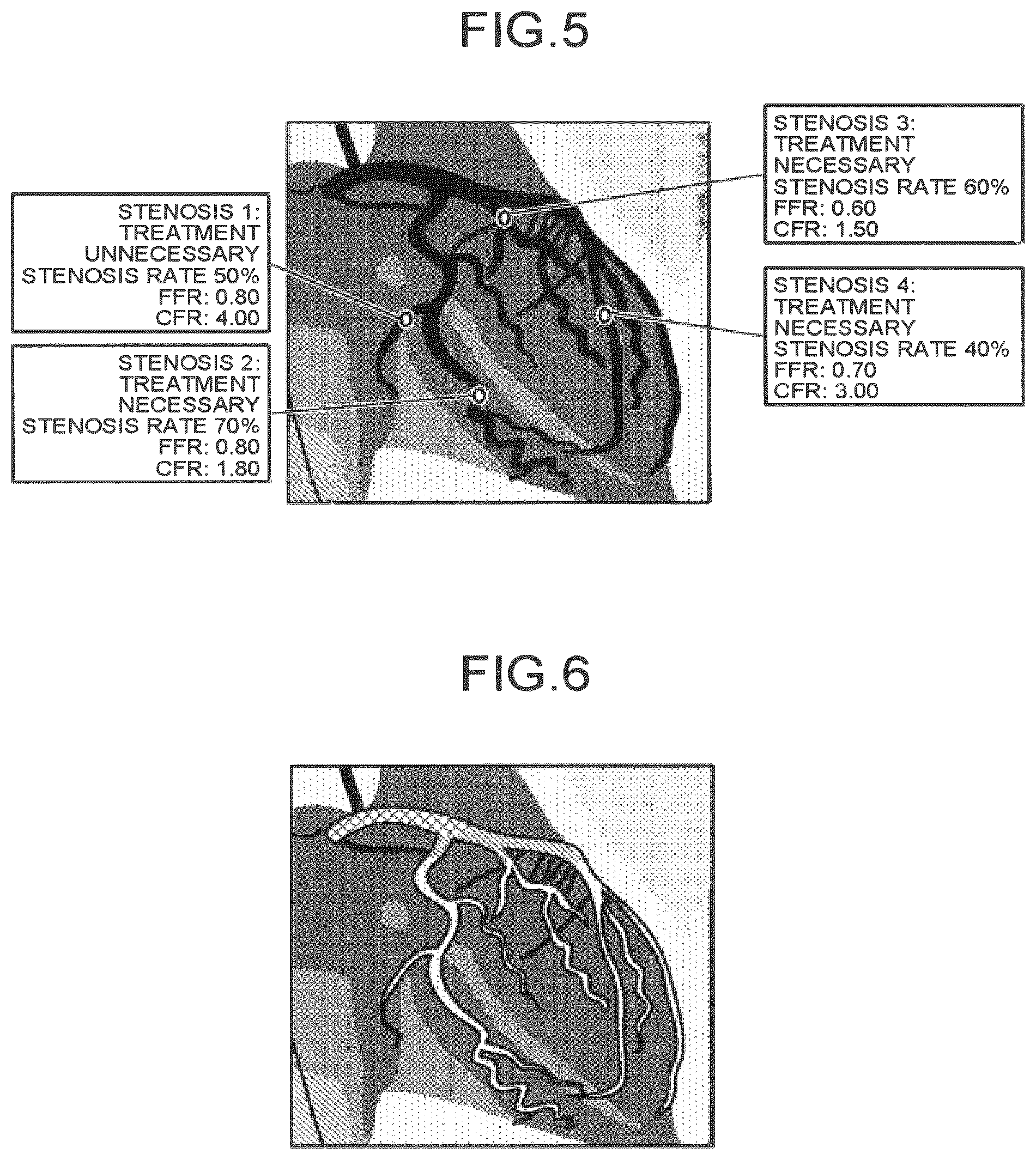 Patent US12586191 Figure 5 – Image processing apparatus, medical image diagnostic apparatus, and blood pressure monitor