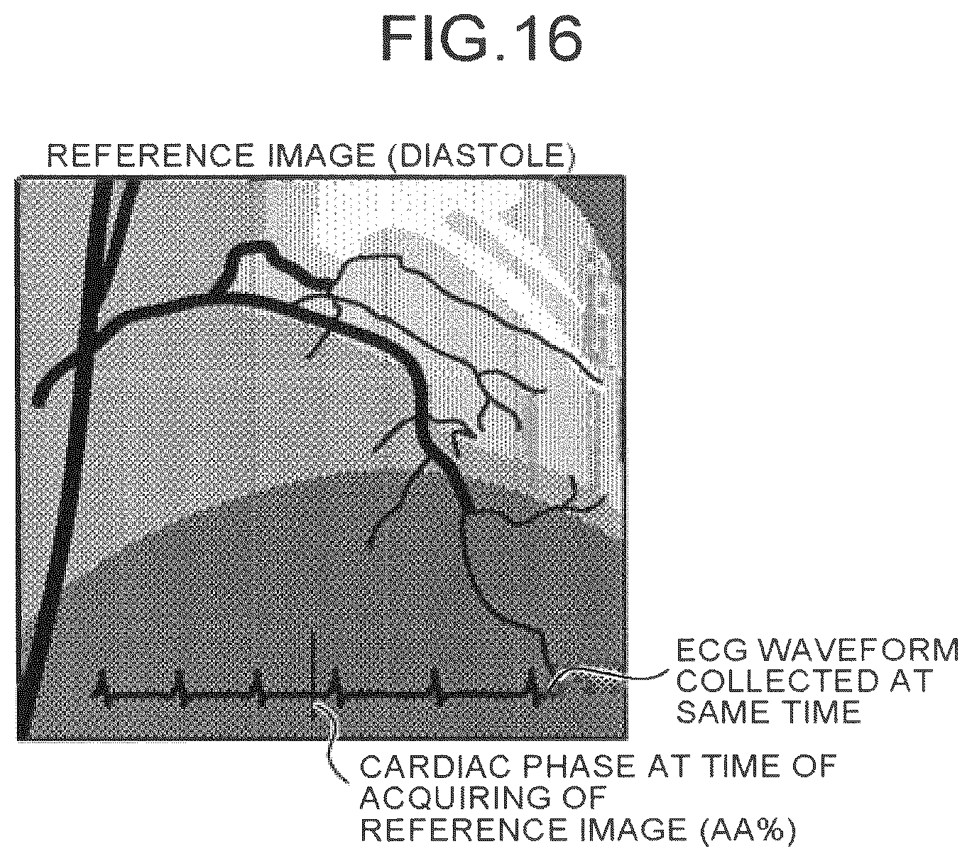 Patent US12586191 Figure 14 – Image processing apparatus, medical image diagnostic apparatus, and blood pressure monitor