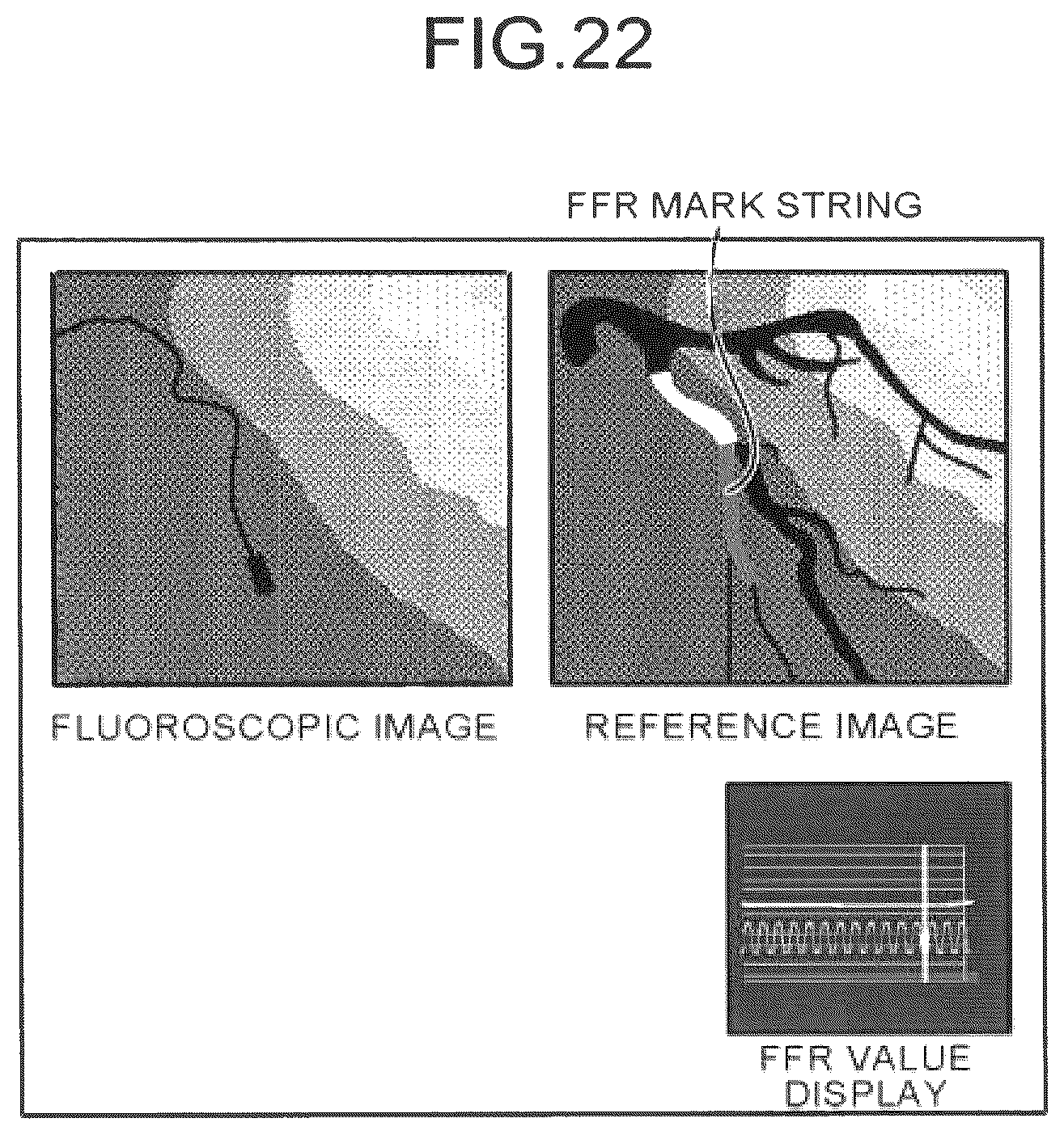 Patent US12586191 Figure 19 – Image processing apparatus, medical image diagnostic apparatus, and blood pressure monitor