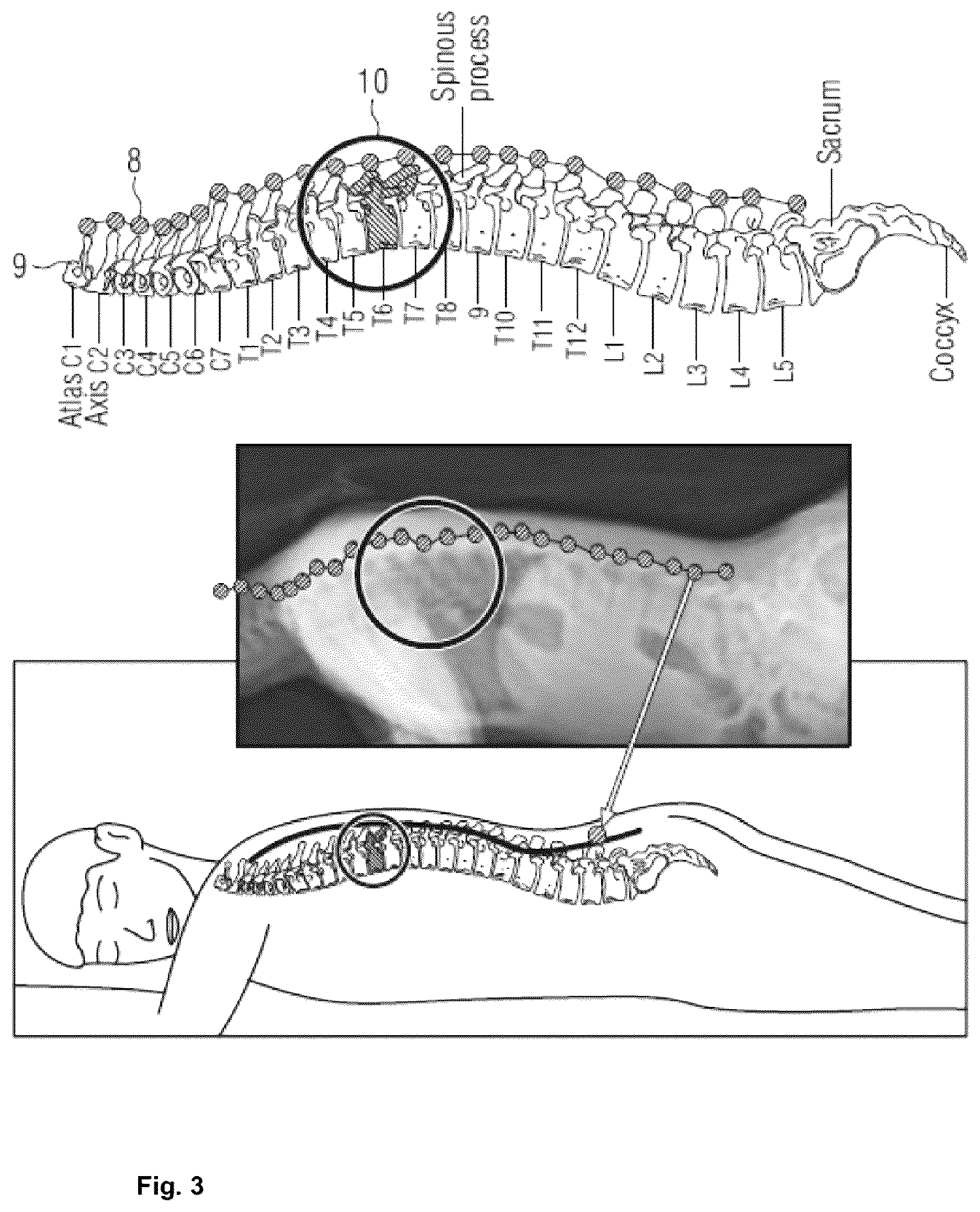 Patent US12586324 Figure 3 – Spine level determination using augmented reality