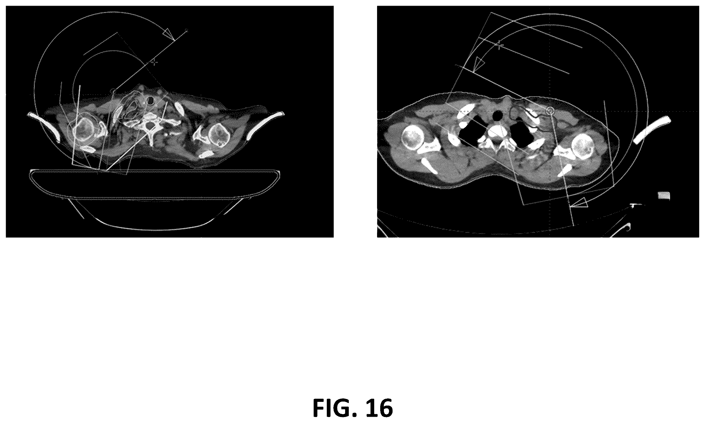 Patent US12586672 Figure 17 – Intelligent treatable sectors for radiation therapy plan generation