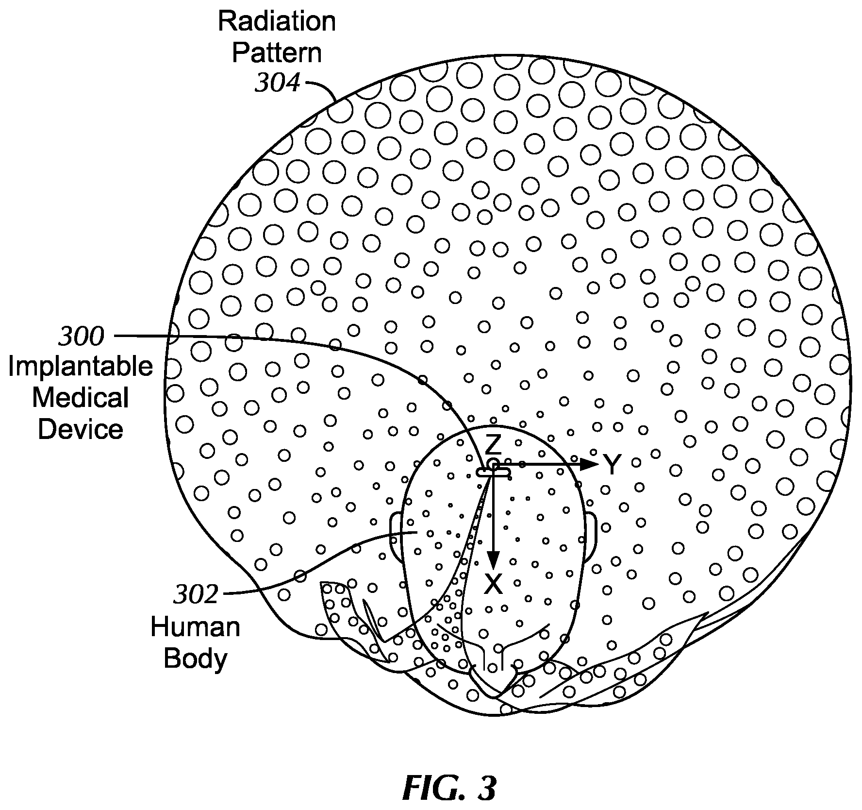 Patent US12586892 Figure 4 – Implant antenna device and system