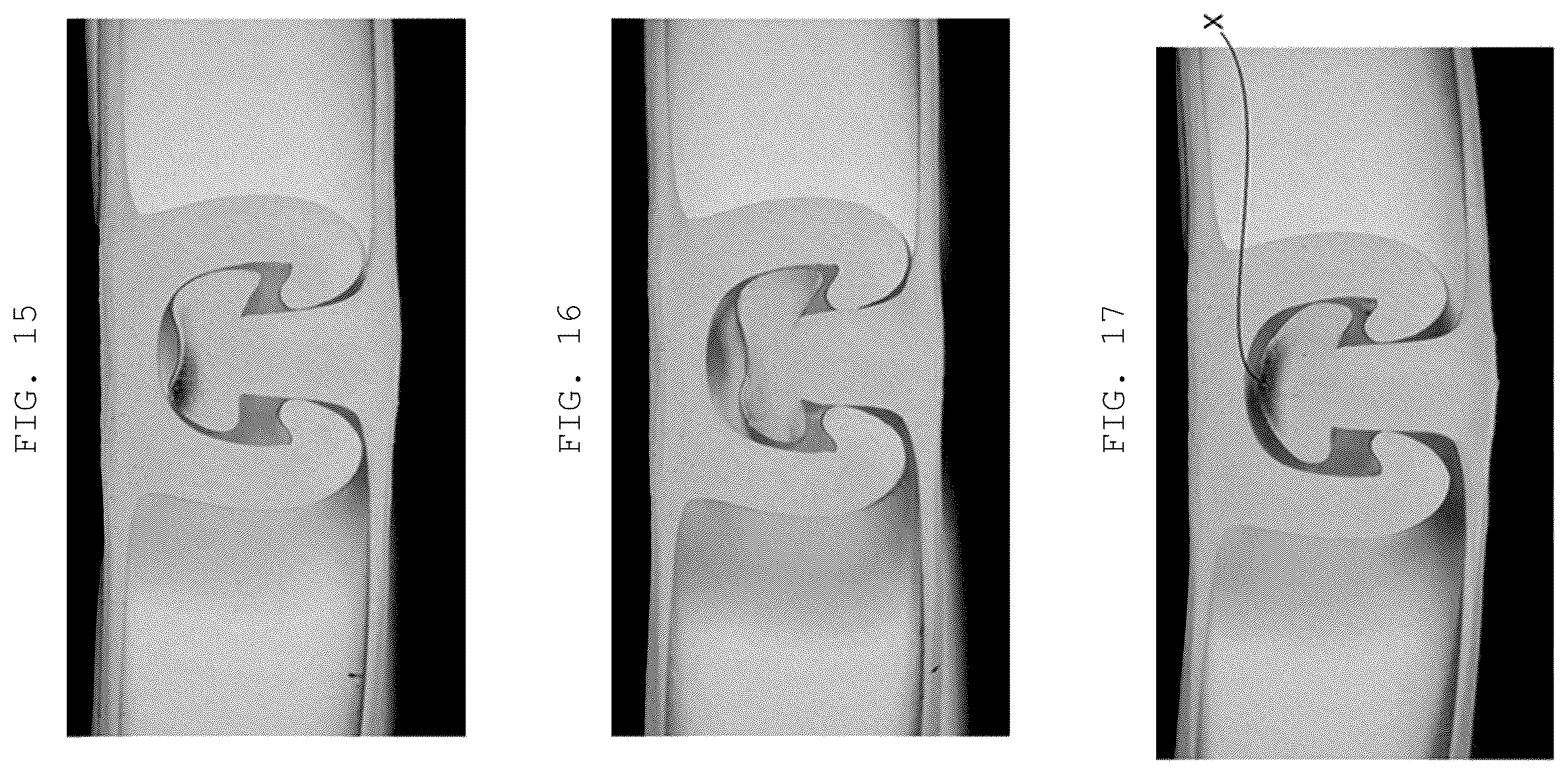 Patent US12588739 Figure 12 – Zipper strap structure, packaging bag comprising zipper strap structure, and manufacturing method for zipper strap structure
