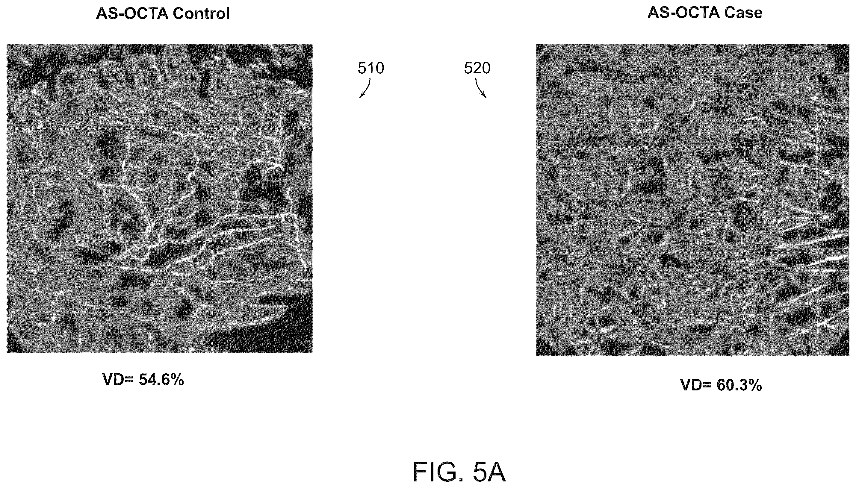 Patent US12588809 Figure 5 – Systems and methods for determining tissue inflammation levels of the eye from blood vessel characteristics