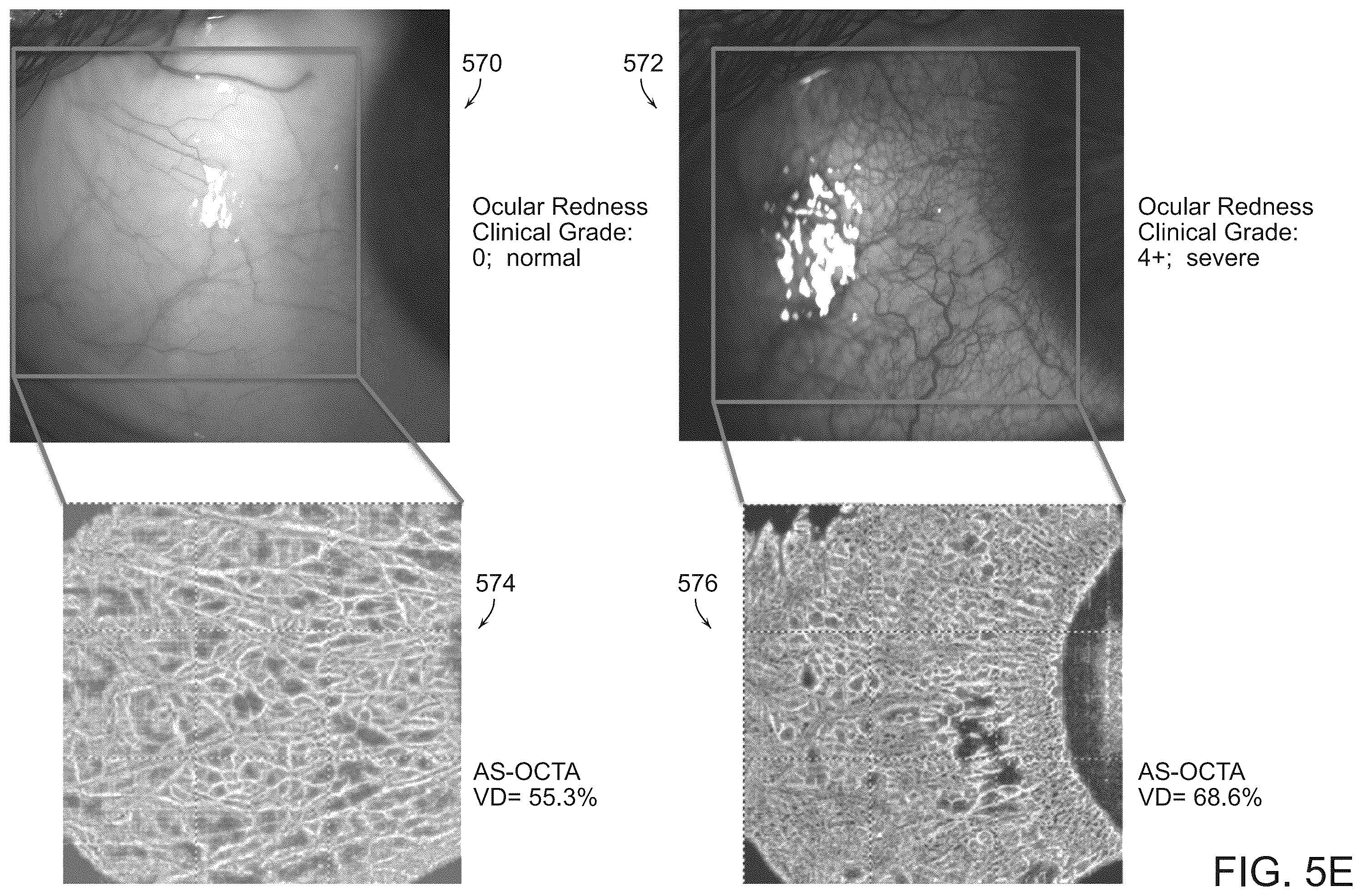 Patent US12588809 Figure 9 – Systems and methods for determining tissue inflammation levels of the eye from blood vessel characteristics