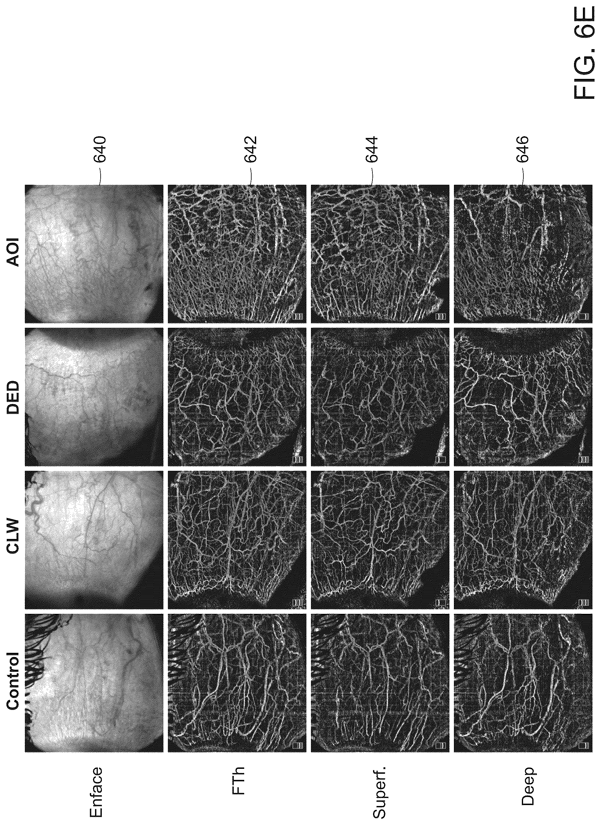 Patent US12588809 Figure 14 – Systems and methods for determining tissue inflammation levels of the eye from blood vessel characteristics