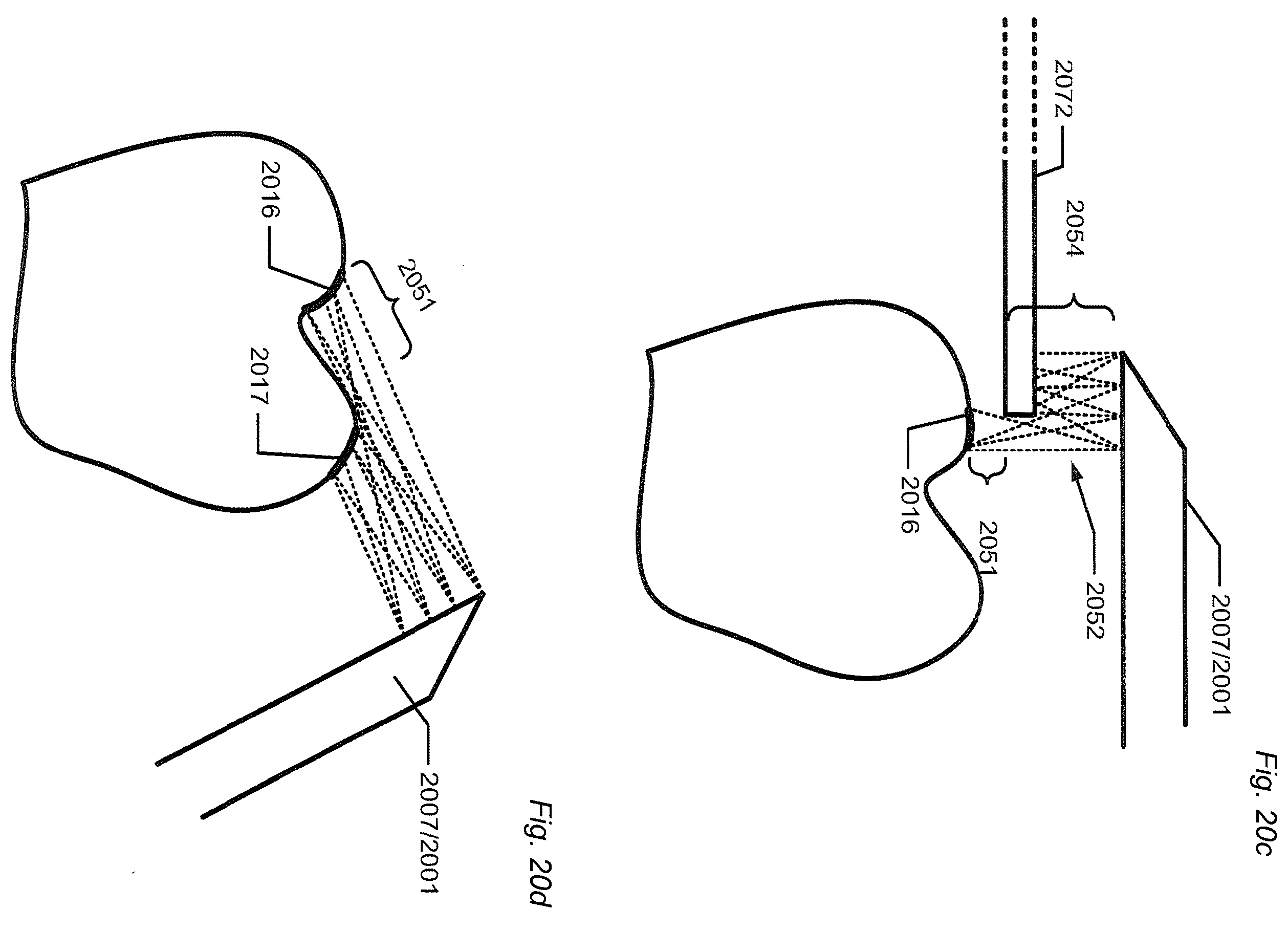 Patent US12588818 Figure 19 – Detection of a movable object when 3D scanning a rigid object