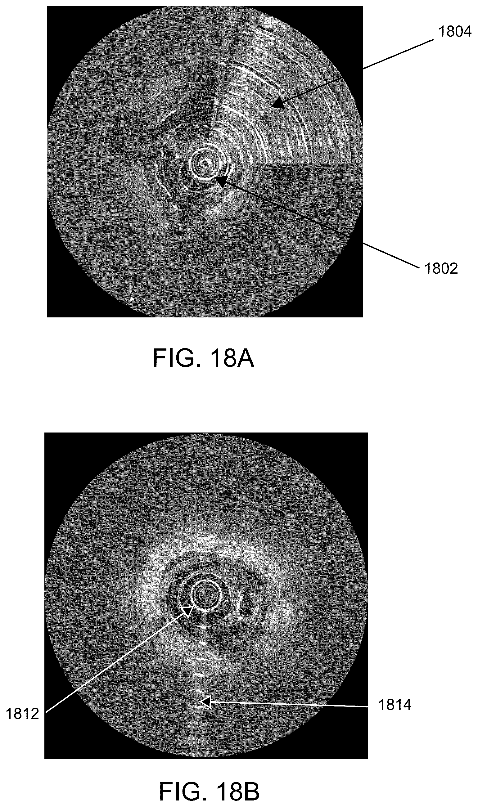 Patent US12588819 Figure 18 – Oct catheter with low refractive index optical material