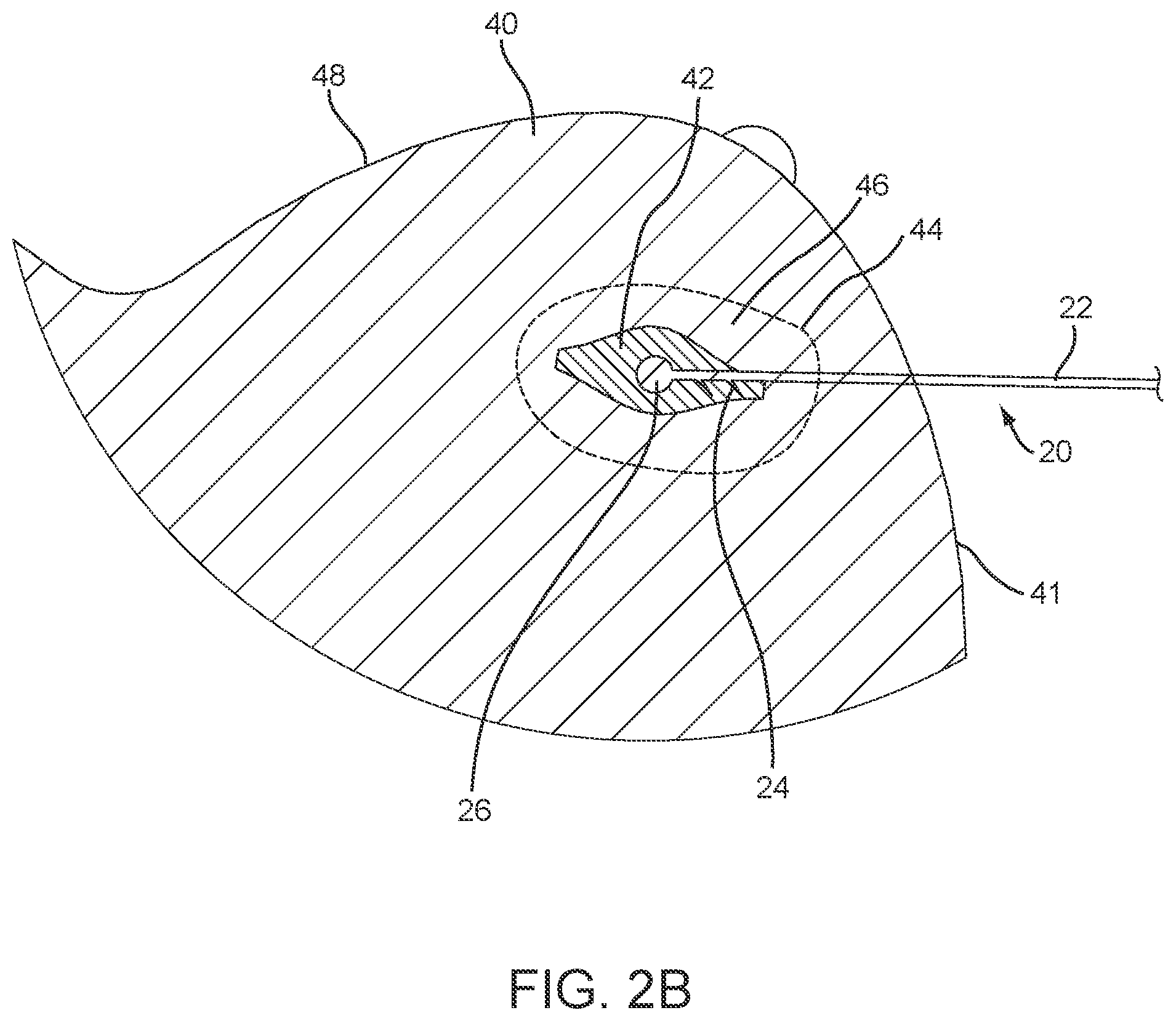 Patent US12588829 Figure 3 – Apparatus, systems, and methods for localizing markers or tissue structures within a body