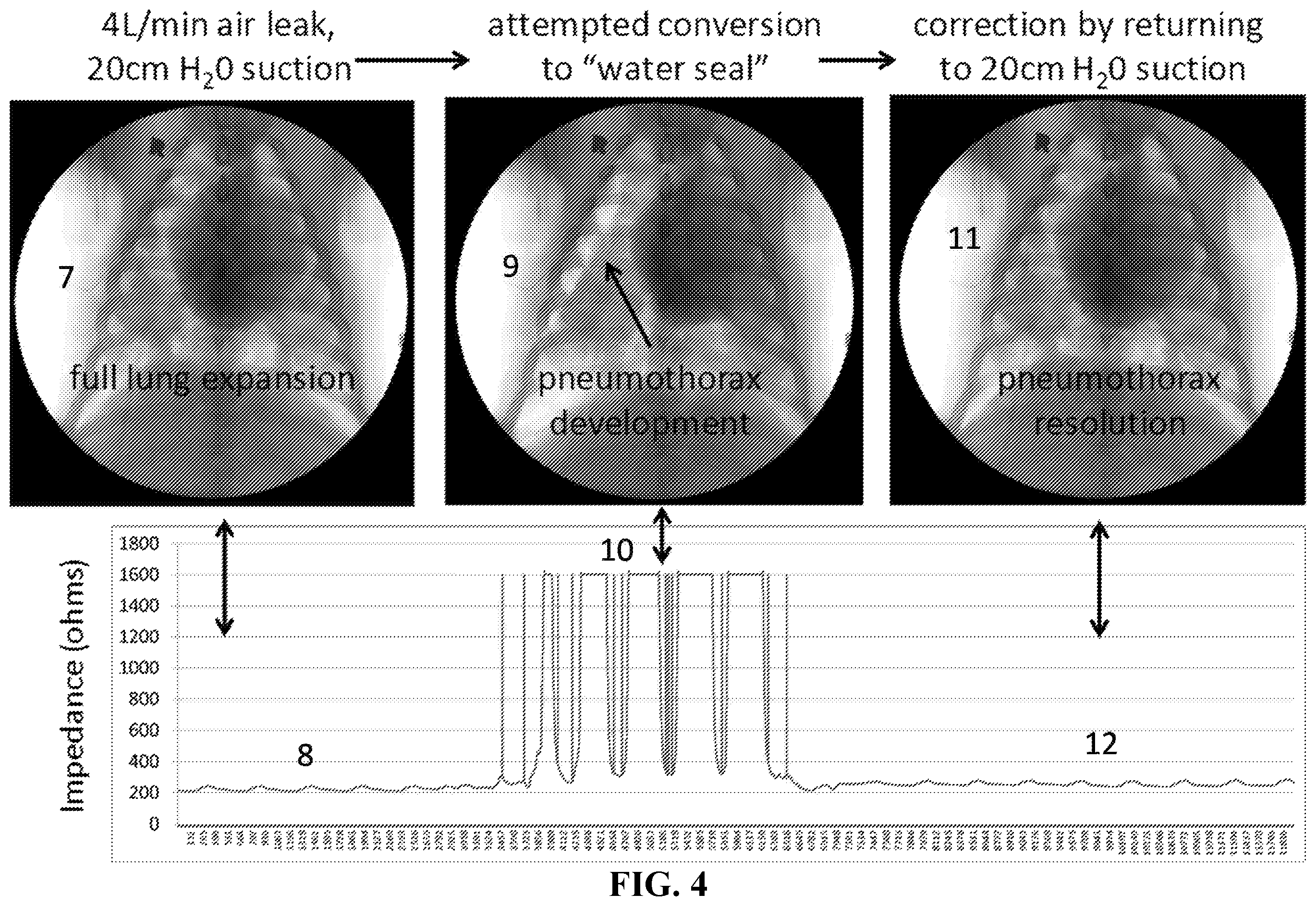 Patent US12588831 Figure 4 – Method for monitoring lung integrity