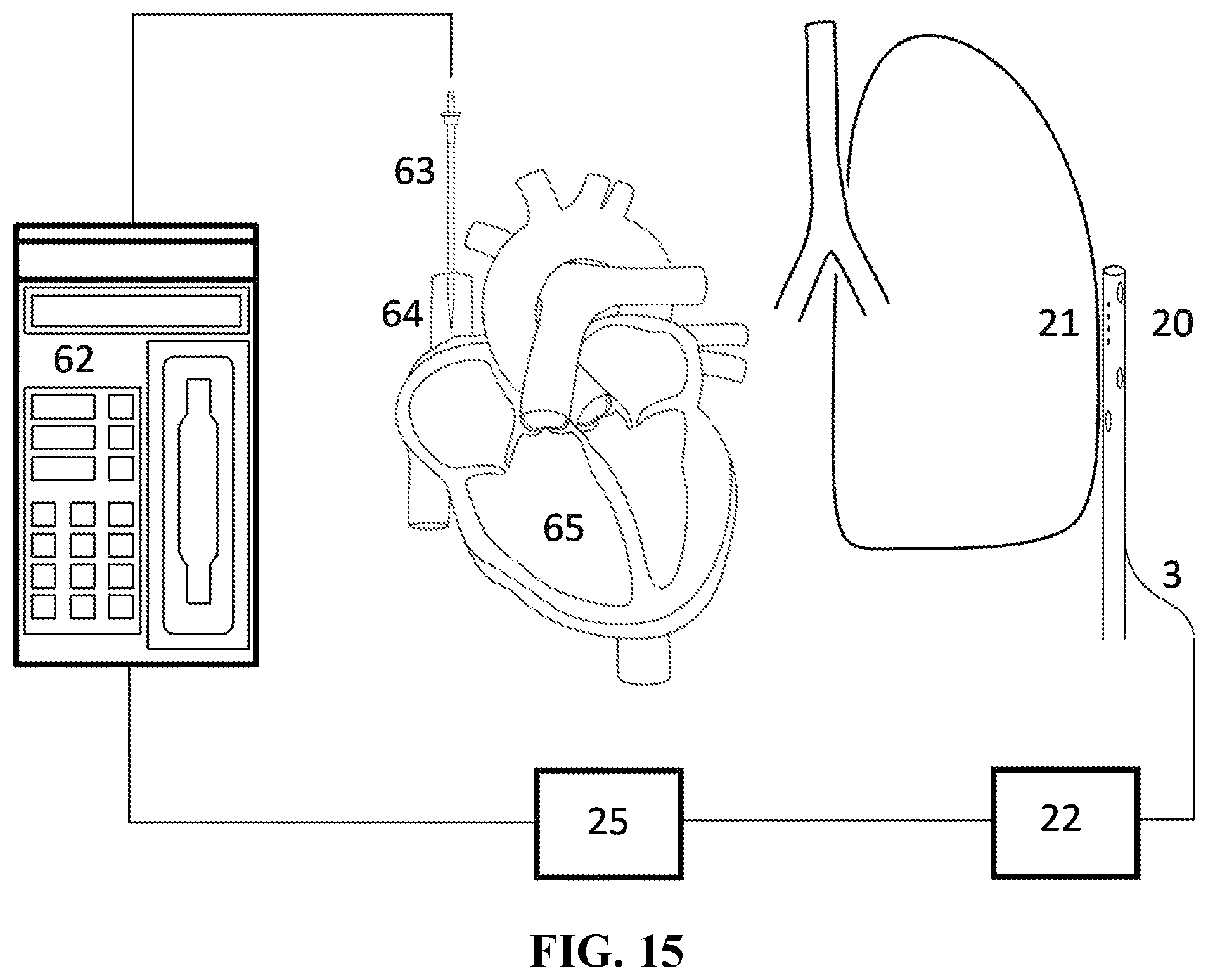 Patent US12588831 Figure 15 – Method for monitoring lung integrity