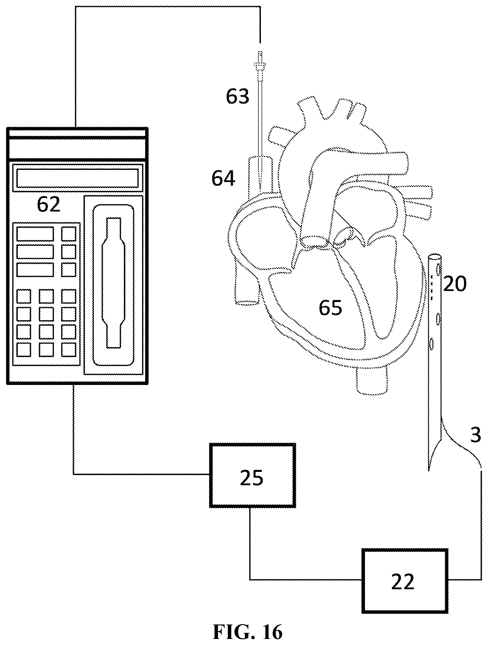 Patent US12588831 Figure 16 – Method for monitoring lung integrity