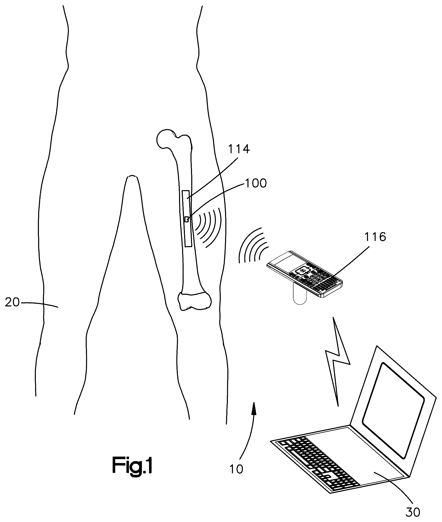 Patent US12588864 Figure 1 – Sensors implantable into a patient's body, systems, and methods of using the same
